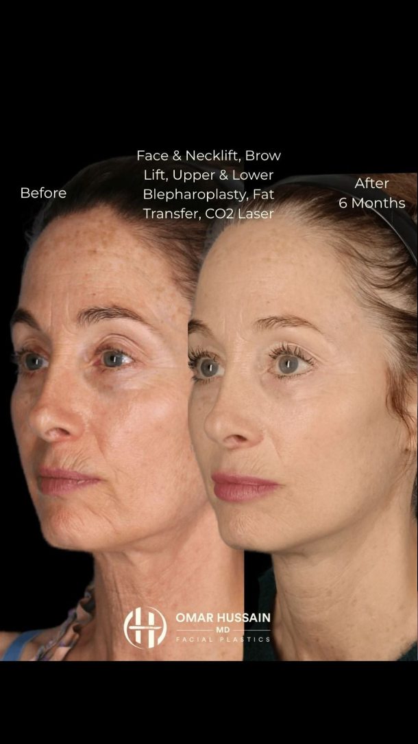 Nina is glowing after her facelift, brow lift, upper blepharoplasty, CO2 laser, and fat transfer — and she couldn’t be happier. Her transformation speaks for itself, and so does her confidence.
#FaceliftTransformation #BrowLift #Blepharoplasty #FatTransfer #CO2Laser