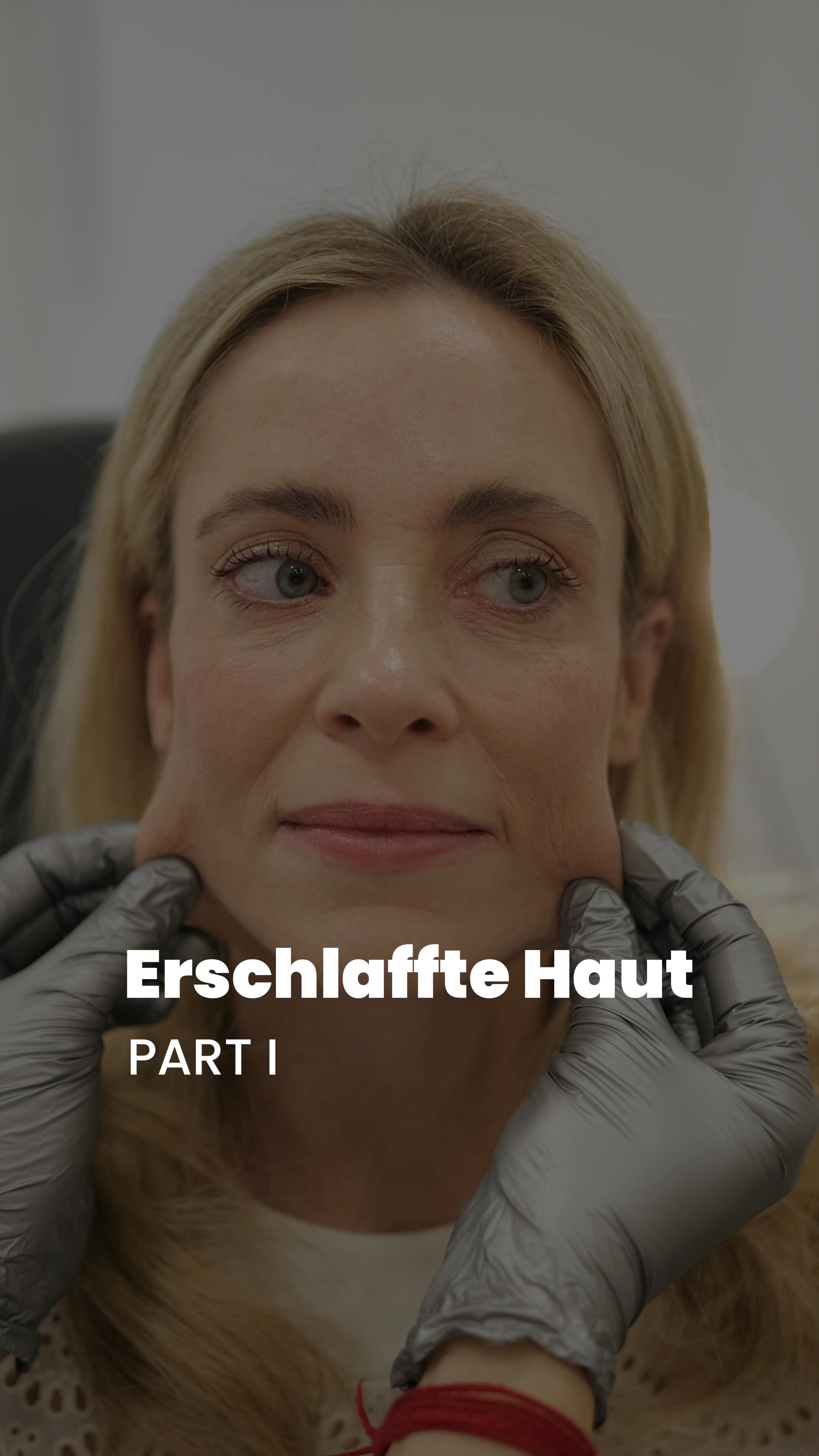 Erschlaffte Haut ohne OP wieder straffen?😊
Bei meiner lieben Patientin hat die Haut im Laufe der Jahre sichtbar an Spannkraft verloren. Die natürliche Elastizität nimmt ab, feine Linien und ein leicht abgesunkener Effekt im Gesicht treten stärker hervor. Viele wünschen sich ein strafferes, frischeres Hautbild, ohne gleich zu einer Operation greifen zu müssen.
Mit der Sculptra-Behandlung, einem sogenannten Biostimulator, können wir diesen Prozess Schritt für Schritt auf natürliche Weise verbessern. Sculptra regt die körpereigene Kollagenproduktion an, unterstützt die Festigkeit der Haut und sorgt dafür, dass das Gesicht wieder an Volumen und Struktur gewinnt ganz ohne Skalpell. Die Ergebnisse bauen sich langsam auf, wirken sehr harmonisch und lassen die Haut sichtbar straffer erscheinen.
Freut euch auf die Ergebnisse, die nicht nur die Haut, sondern auch das gesamte Gesicht harmonischer wirken lassen. Geduld zahlt sich aus und jede Behandlung wird individuell auf das Gesicht abgestimmt, um ein natürliches, frisches Ergebnis zu erzielen.
Eure Fachärztin Fr. Ludewig ✨
#sculptra #erschlafftehaut #biostimulator #hängebäckchen #ludewig