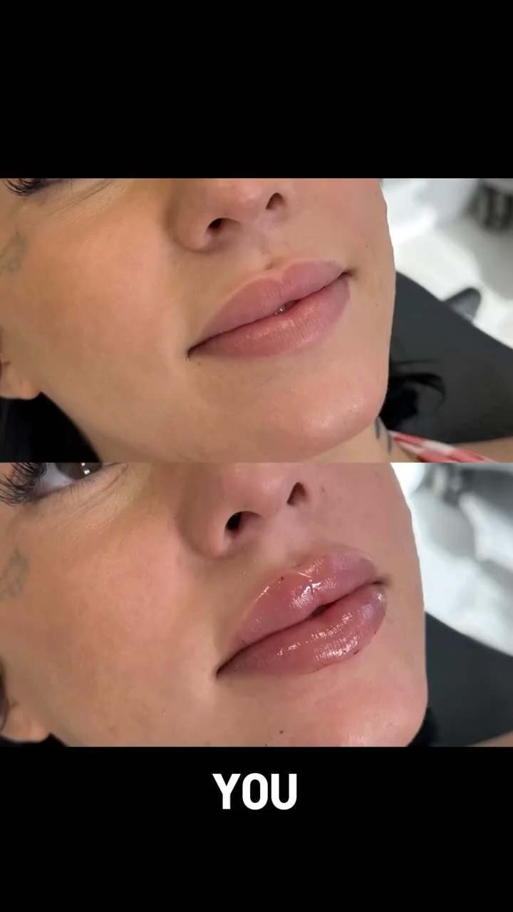 Enhance what’s already yours.
Lip fillers are not about changing your face — they’re about refining your natural beauty, adding balance, and creating a look that feels like you, just elevated. Subtle volume, smooth definition, and confidence in every smile.
Call or text today to book your appointment!
☎️ 239-448-3383
📩 chris.jewell@jewellmedicalspa.com
🌐 www.jewellmedicalspa.com | www.mrinjectable.com
📍 1044 Castello Drive, Ste 213 Naples Florida 34103
💳 We Accept Care Credit!
*
*
*
#lipfiller #lipfillers #lipaugmentation #lipplump #lipinjection #lipenhancement
#lipcontouring #restylanelips #injectables #dermalfillers #cosmeticinjectables #aesthetics #beauty #restylane #restylaneusa #naplesbeauty #naplesinjector #medspa #dolllips #lippies #bestaestheticinjectors #beforeandafter