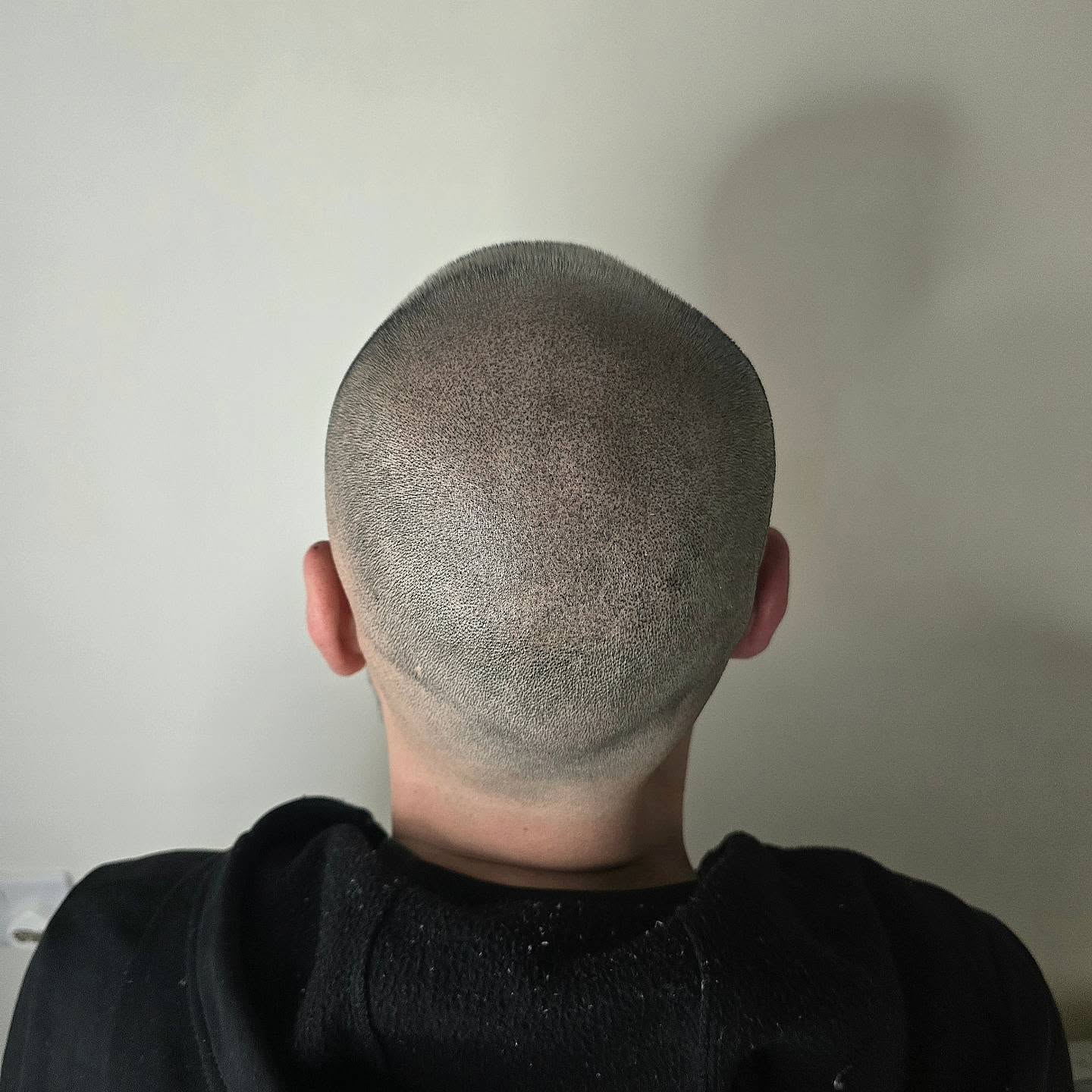 CROWNS
Using Scalp Micro-Pigmentation (SMP) for concealing thinner areas!
Cosmetic tattooing for hair loss is a game changer! Results from first treatment!
This was taken after 3rd and final session!
📍Bury St Eds & Brighton Studios
#hairloss #hairlosssolution #hairlossremedy #Rosemaryoil #rogaine #hairttattoo #hairtransformation #hairtransplantalternative #hairregrowthtreatment #recedinghairline #menshair #prp #prptreatment #buzzcut