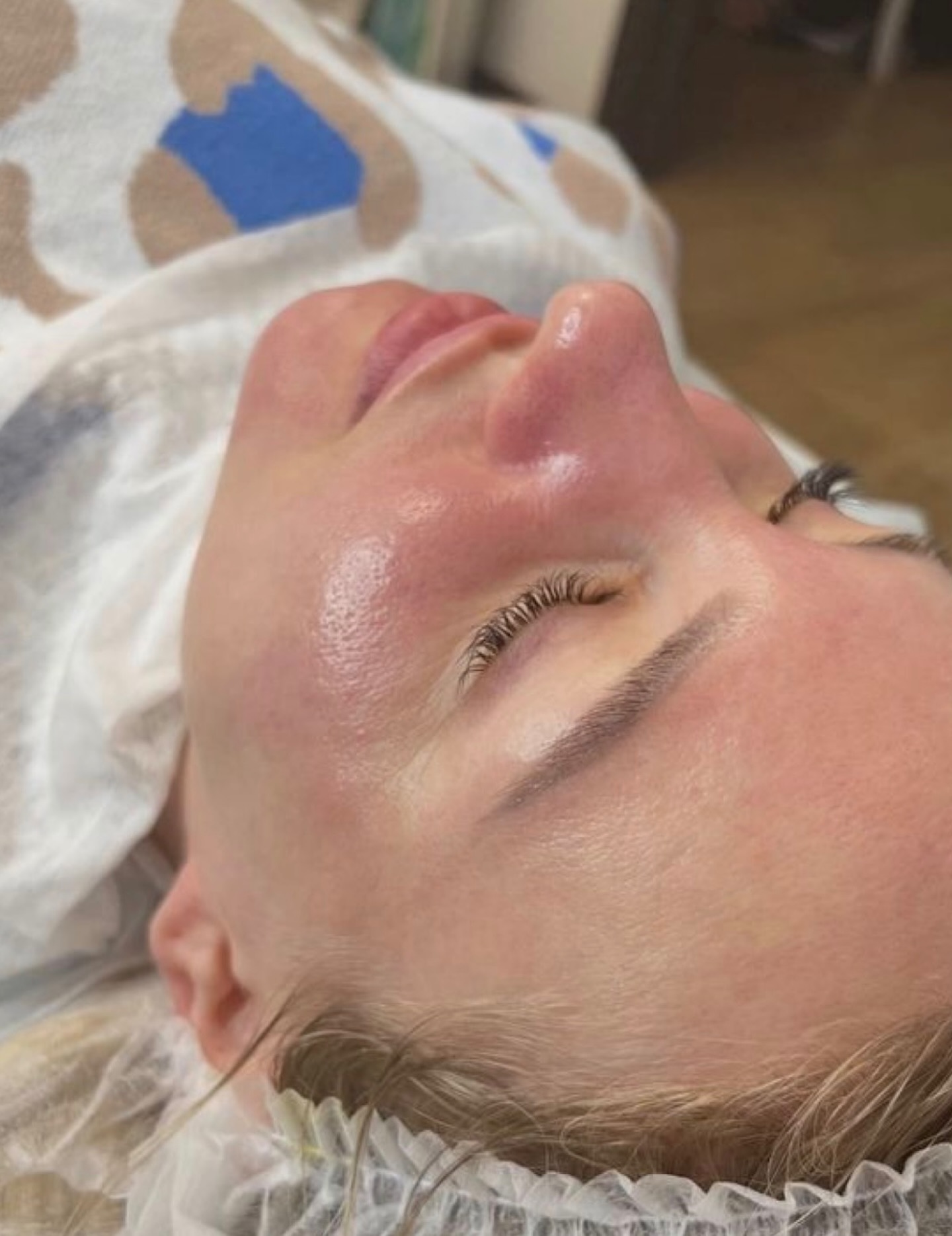 🔬 Advanced Chemical Peeling
Chemical peeling is a scientifically grounded dermatological procedure designed to accelerate cellular turnover and restore the skin’s physiological balance. By carefully controlled exfoliation, this treatment stimulates regeneration processes at a deeper level, revealing a smoother, more uniform, and visibly revitalized complexion.
Indications include:
• Dyschromia and uneven skin tone
• Acne and post-inflammatory lesions
• Fine lines and early signs of photoaging
• Loss of skin luminosity and texture irregularities
Our protocols are tailored to individual skin types, ensuring both efficacy and safety through professional assessment and application.
Invest in evidence-based skin renewal and experience clinically inspired results.
📩 For consultations and appointments, please contact us.