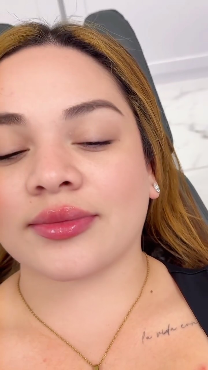 Subtle, natural, and confidence-boosting ✨
Lip fillers are all about enhancing what you already have—adding volume, improving symmetry, and creating that soft, hydrated look that photographs beautifully in every light. No overdone results, just a refreshed version of you.
Call or text today to book your appointment!
☎️ 239-448-3383
📩 chris.jewell@jewellmedicalspa.com
🌐 www.jewellmedicalspa.com | www.mrinjectable.com
📍 1044 Castello Drive, Ste 213 Naples Florida 34103
💳 We Accept Care Credit!
*
*
*
#lipfiller #lipfillers #lipaugmentation #lipplump #lipinjection #lipenhancement
#lipcontouring #restylanelips #injectables #dermalfillers #cosmeticinjectables #aesthetics #beauty #restylane #restylaneusa #naplesbeauty #naplesinjector #medspa #dolllips #lippies #bestaestheticinjectors #beforeandafter