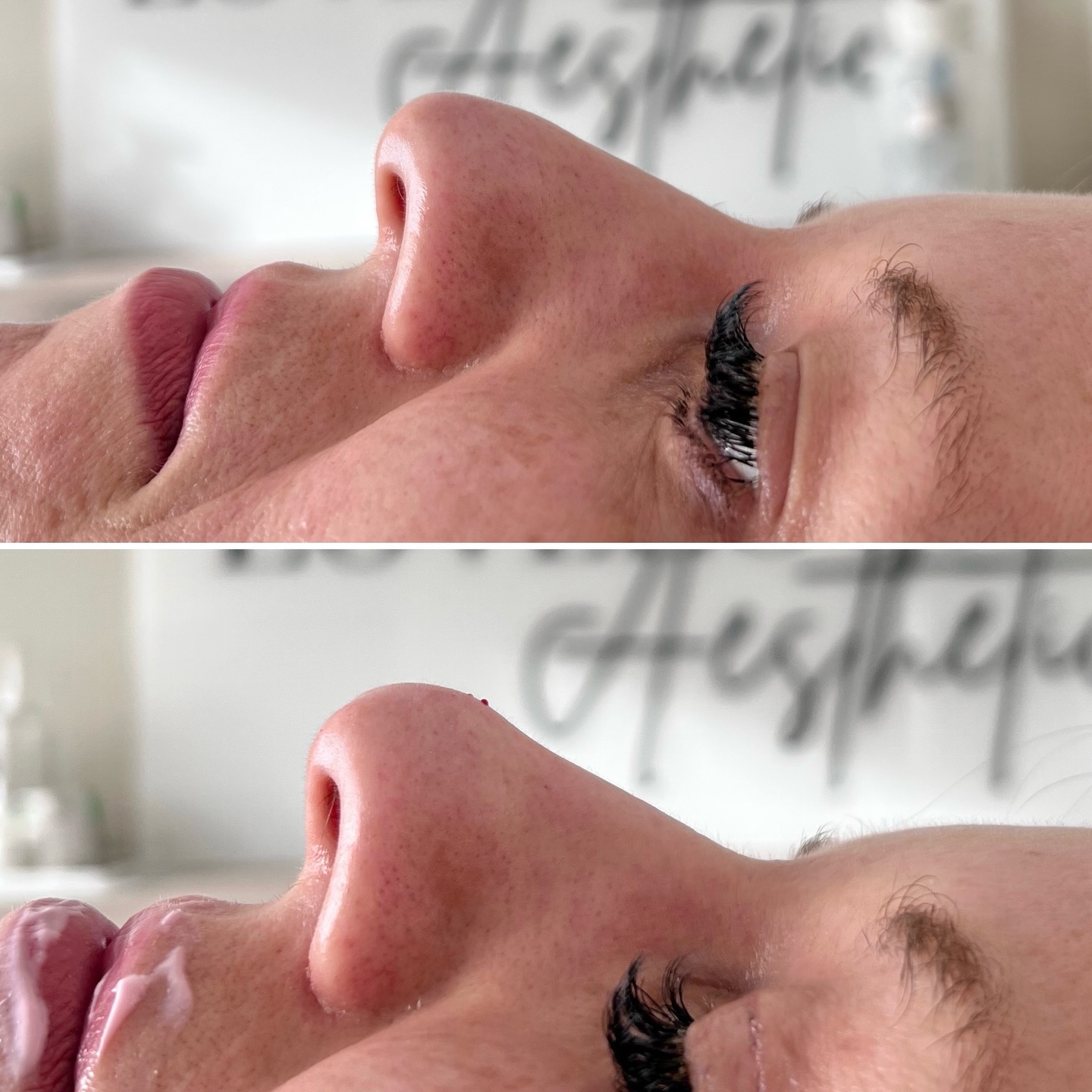 Another amazing nose transformation!
NO NEED FOR PAINFUL SURGERY!
If you’re looking to change your side profile, it can easily be done! Just look at these amazing results on my clients
⭐️ Award-winning level 7 aesthetics practitioner
📍 Romsey 📍 Warminster
#warminster #westbury #trowbridge #romsey #southamptonuk