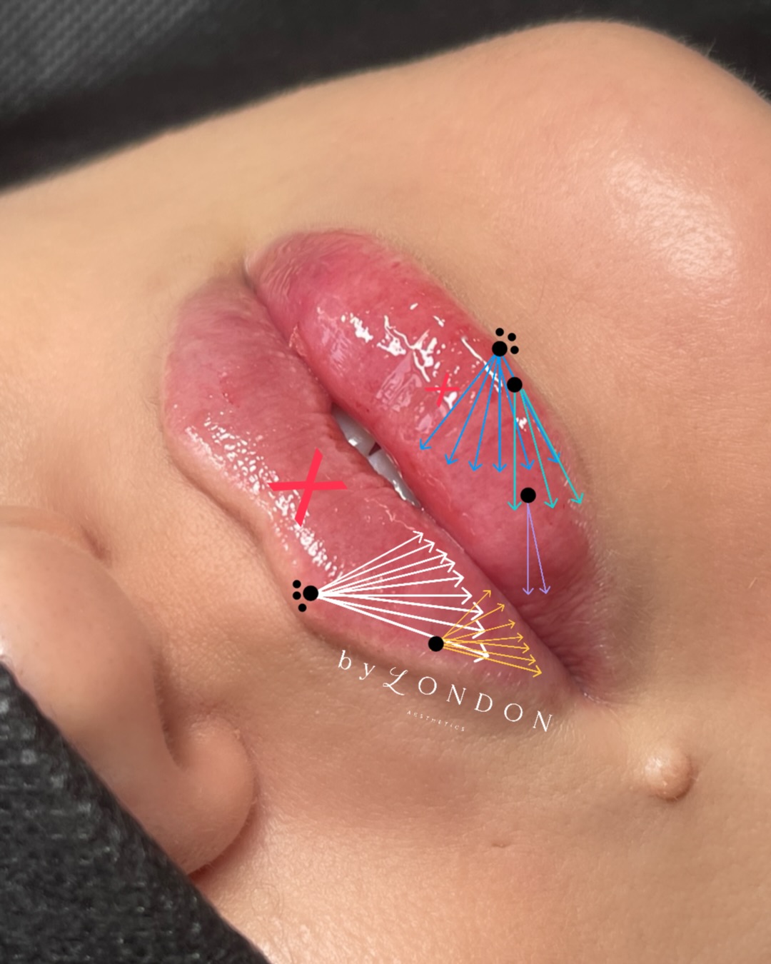 A two session refill following a dissolve, and I always love to share healed results….so you can see how natural russian lips can look.
Many clients who are new to this technique, have a perception russian lips are ‘bigger’ than classics.
But what they’re viewing on Instagram is multiple session builds….and swelling. Photos are taken minutes after complex injection patterns which create inflammation. This can account for 50-60% of the ‘size’ they think they’re seeing online.
Russian lips are flat and heart shaped. Not bigger. To build up volume you build up sessions, no matter the technique.
I have only 3 spaces left this week before I’m away from Monday, if you would like to take one of these slots please DM asap 👉🏽📱
𝗕 𝗬 𝗟 𝗢 𝗡 𝗗 𝗢 𝗡 𝗔 𝗘 𝗦 𝗧 𝗛 𝗘 𝗧 𝗜 𝗖 𝗦
📍 High Road, Wood Green, North London
▪️ Russian Lips
▪️ Full Facial Contouring + Balance
▪️ Liquid Rhinoplasty + Pixie Tip Lift
▪️ Skin Boosters, Polynucleotides + Exosomes
▪️ Anti Wrinkle Advanced
▪️ PDO Threads
📃 𝗖𝗣𝗗 𝗔𝗰𝗰𝗿𝗲𝗱𝗶𝘁𝗲𝗱 𝗧𝗿𝗮𝗶𝗻𝗶𝗻𝗴 𝗳𝗼𝗿 𝗔𝗲𝘀𝘁𝗵𝗲𝘁𝗶𝗰 𝗜𝗻𝗷𝗲𝗰𝘁𝗼𝗿𝘀
👩🏻🎓 Pathway & Beginners Packages
🥇 Advanced Level Masterclasses
💻 Online Courses available
📞 WhatsApp 07774 054 013
#russianlips #russianlipfiller #naturallips #naturallipfiller #healedlipfiller