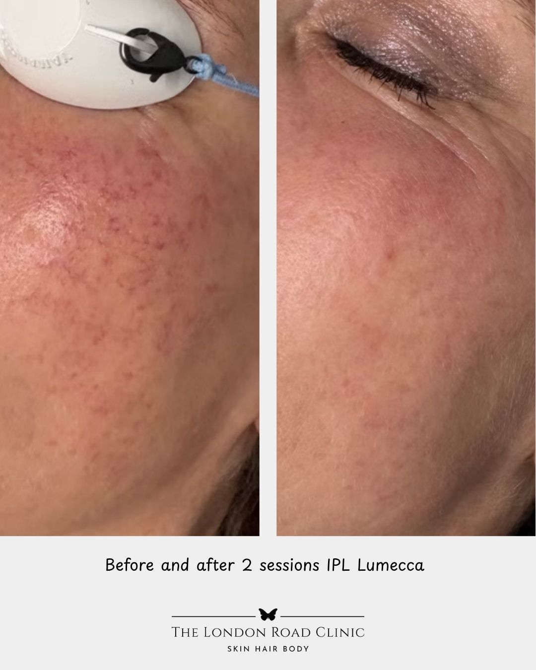 The power of Lumecca IPL ✨✨
Check out this incredible before and after.. just 2 sessions of IPL Lumecca !! ⚡
This treatment targets:
🪄 Sun damage
🪄 Freckles
🪄 Pigmentation
🪄 Redness & broken capillaries
For more information or book a consultation to coerce and speak to our skin practitioners contact us today!
📍London Road Clinic: 65 London Road, Newark NG24 1RZ
📞 01636 680767
📧 hello@londonroadclinic.com
🔗 Booking link in bio