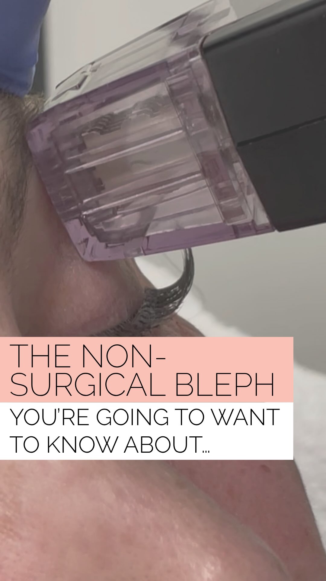 You’ve heard of Morpheus8, but have you heard about Morpheus& Resurfacing Tip?
Morpheus& Resurfacing Tip is a specialized non-surgical, fractional radiofrequency (RF) microneedling treatment designed for the delicate skin around the eyes (upper/ lower eyelids, crow’s feet) to treat sagging, wrinkles, and bags.
Utilizing a 24- pin tip (0.5mm) it stimulates collagen to tighten skin and reduce hooding with 1-3 sessions typically recommended for lasting rejuvenated results. No surgery necessary.
*results shown are after one M8 Eye Resurfacing Treatment
* Add to Face/Sculptor: $500
* Standalone: $800
Call, text or DM for more information and how to book your M8 Eyes!