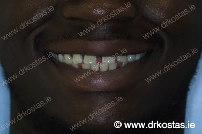 Whether it's crowding or spacing, there is always an orthodontic solution and we have you covered. Contact us today to arrange your 100% FREE Initial Consultation with Dr. Kostas to discuss your treatment needs. Trust your smile to a reputable specialist 😁🙌
#drkostas #kostasortho #orthodontist #braces #dublin #smile #smilecurve #smilearc #orthodontics #straightteeth #damonbraces #cosmeticdentistry #smilemakeover #smiletransformation