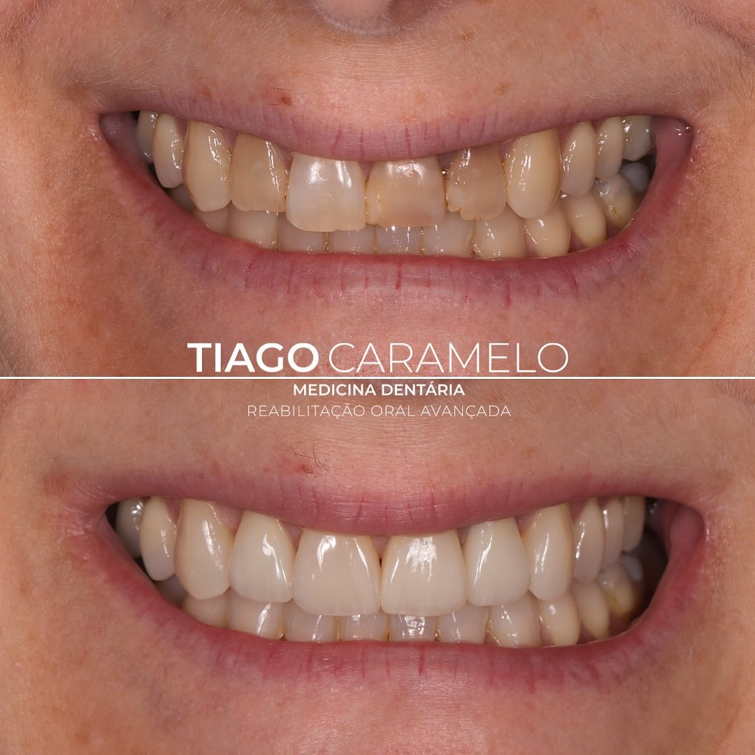 A estética do setor anterior é fundamental para um sorriso bonito e natural e, muitas vezes, pode ser afetada por restaurações ou alterações de cor em dentes desvitalizados. Neste caso em específico, comecei por realizar branqueamento dentário através de moldeiras, de forma a tornar os dentes mais brancos antes de me debruçar sobre os elementos anteriores. Posteriormente, realizei 3 coroas nos dentes que já se encontravam escuros e desvitalizados e 1 faceta no incisivo central restante, com o objetivo de repor a forma e a cor destes dentes. Acabei por conseguir igualar a cor dos substratos que não eram de todo fáceis e que tornaram este caso um autêntico desafio.
Trabalho laboratorial realizado por: @margarida.msr
Obrigado @fatty_carvalho pela confiança no meu trabalho!
—————————————————————————————
The aesthetics of the anterior region are essential for a beautiful and natural smile and are often impacted by restorations or discoloration in non-vital teeth. In this specific case, I started by performing teeth whitening using trays to achieve a whiter shade before focusing on the anterior elements. Subsequently, I placed three crowns on the already non-vital teeth and one veneer on the remaining central incisor, aiming to restore the shape and color of these teeth. I managed to match the color of the substrates, which were far from straightforward, making this case a true challenge.
Labwork done by: @margarida.msr
Thank you @fatty_carvalho for trusting my work!
#oralrehabilition #ceramiccrown #ceramicveneer #bleaching #maloclinic