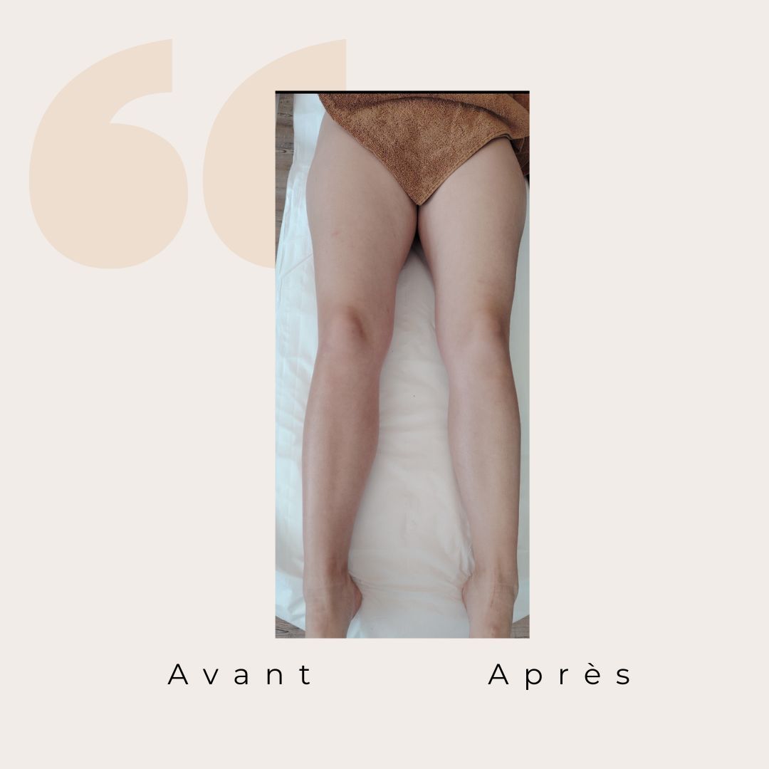 ✨ Avant / Après – Drainage lymphatique Renata França ✨
Dès la première séance, le corps réagit.
Des jambes visiblement plus légères, un galbe redessiné et une sensation immédiate de bien-être 🌿
Le drainage lymphatique Renata França agit en profondeur pour :
✨ stimuler la circulation lymphatique
✨ réduire la rétention d’eau
✨ affiner et détoxifier les jambes
✨ apporter une sensation de légèreté durable
Résultat visible, ressenti immédiat 🤍
Chaque corps est unique, les résultats peuvent varier, mais la légèreté, elle, est toujours au rendez-vous ✨
#drainagelymphatique #renatafranca #avantapres #jambeslegeres #retentiondeau #bienetre #soincorps #detox #momentpoursoi