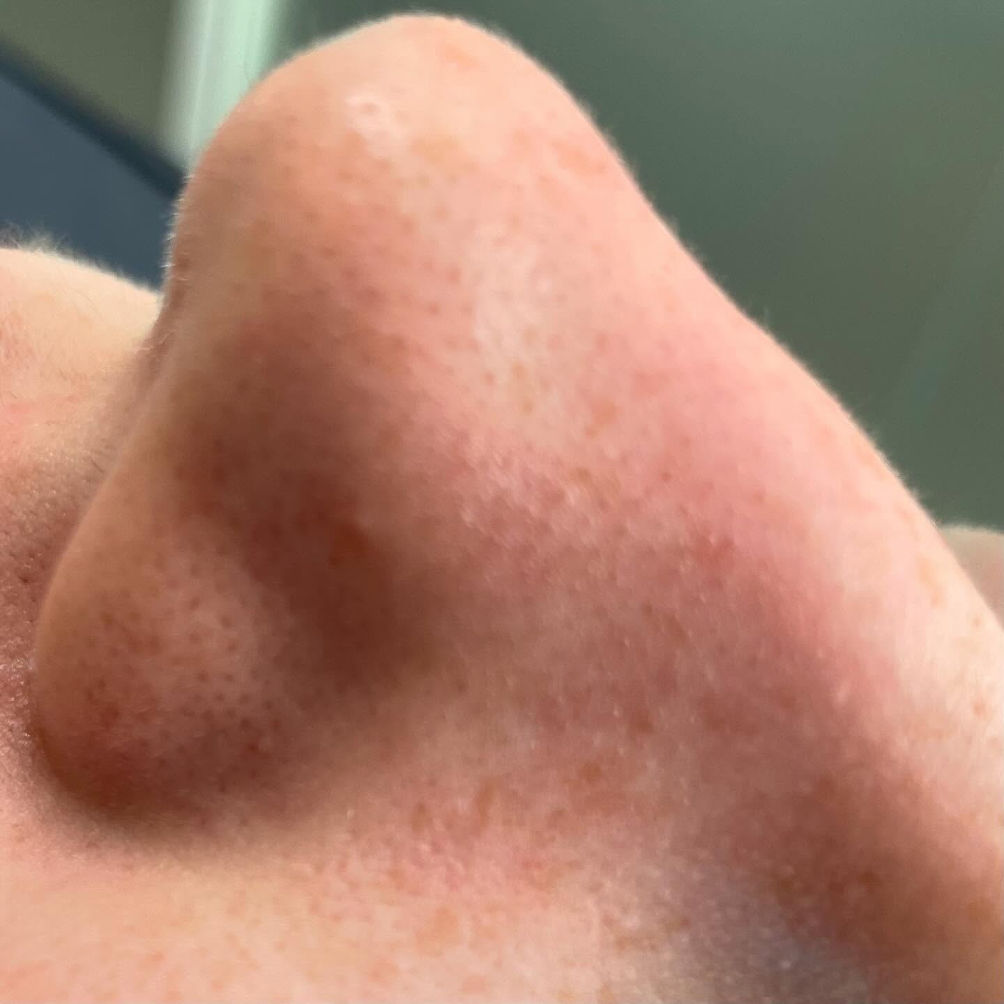 🌟 Say goodbye to those pesky sebaceous filaments with a Hydro2facial! 💧✨ First slide untreated, second slide post treatment.
These natural skin saviors help keep your complexion glowing and often mistaken for blackheads! But sometimes they can get a little too proud. 🚀
A hydro2facial deeply cleanses your pores, leaving your skin refreshed and renewed. Who’s ready to reveal that radiant glow? 😍-
#Hydro2facial#SkincareGoals #GlowingSkin#noseblackheads#SebaceousFilaments #BeautyRoutine 💖