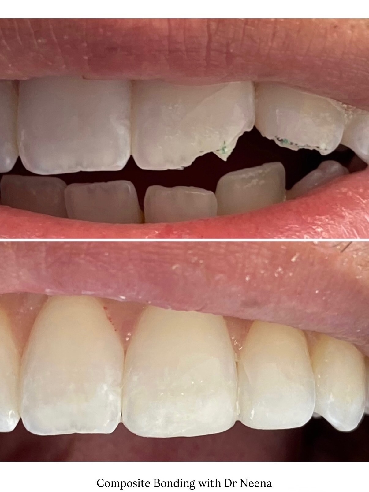 Composite bonding with Dr Nenna 🤍😍
Dreaming of a more confident smile? Composite bonding is one of the quickest and most effective ways to enhance your teeth – whether it’s smoothing chips, closing small gaps, or improving shape and symmetry 🤍
✨ Fun fact: Composite bonding usually requires little to no drilling, which means your natural teeth stay almost completely untouched!
It’s a simple, non-invasive treatment that can completely transform your smile in just one visit – with results that look beautifully natural.
Ready for your glow-up?
Send us a message to book your consultation 📩
0 % Finance options available
📍7 Windsor Way, Knutsford WA16 6JB
🌐 www.kclinic.co.uk
📱 07946 219 539
☎️ 01565 653480
#dentist#compositebonding#transformation#smile#dentalcare