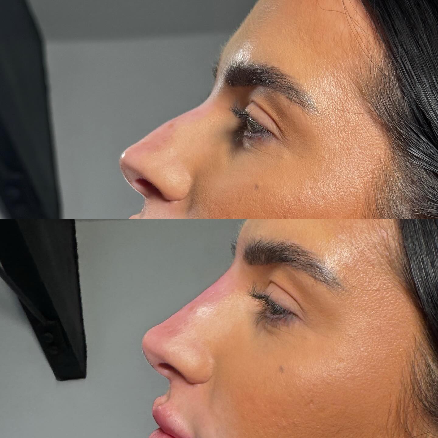 ⠀
✨ Liquid Rhinoplasty ✨
Looking to smooth bumps, lift the tip, or create a more balanced nose without surgery?
Liquid rhinoplasty is a quick, non-surgical treatment that delivers instant results using dermal filler.
💉 Benefits:
• Smooth out bumps and uneven areas
• Lift and define the nasal tip
• Improve overall symmetry and profile
• No surgery
• Reversible
• Immediate results
__________________________
Get in touch 👇🏽
𝐃𝐌 𝐔𝐒 𝐅𝐎𝐑 𝐄𝐍𝐐𝐔𝐈𝐑𝐈𝐄𝐒
GIFT VOUCHERS AVAILABLE
SWIPE FOR CLINIC DATES
⭐️ 5 STAR GOOGLE REVIEWS
💻 www.archedaesthetics.co.uk
📱 𝗪𝐇𝐀𝐓𝐒𝐀𝐏𝐏 07517416782
📧 hello@archedaesthetics.co.uk
#lipfillerplymouth #dermalfillerplymouth #aestheticscallington #dermalfillercallington #aestheticsliskeard