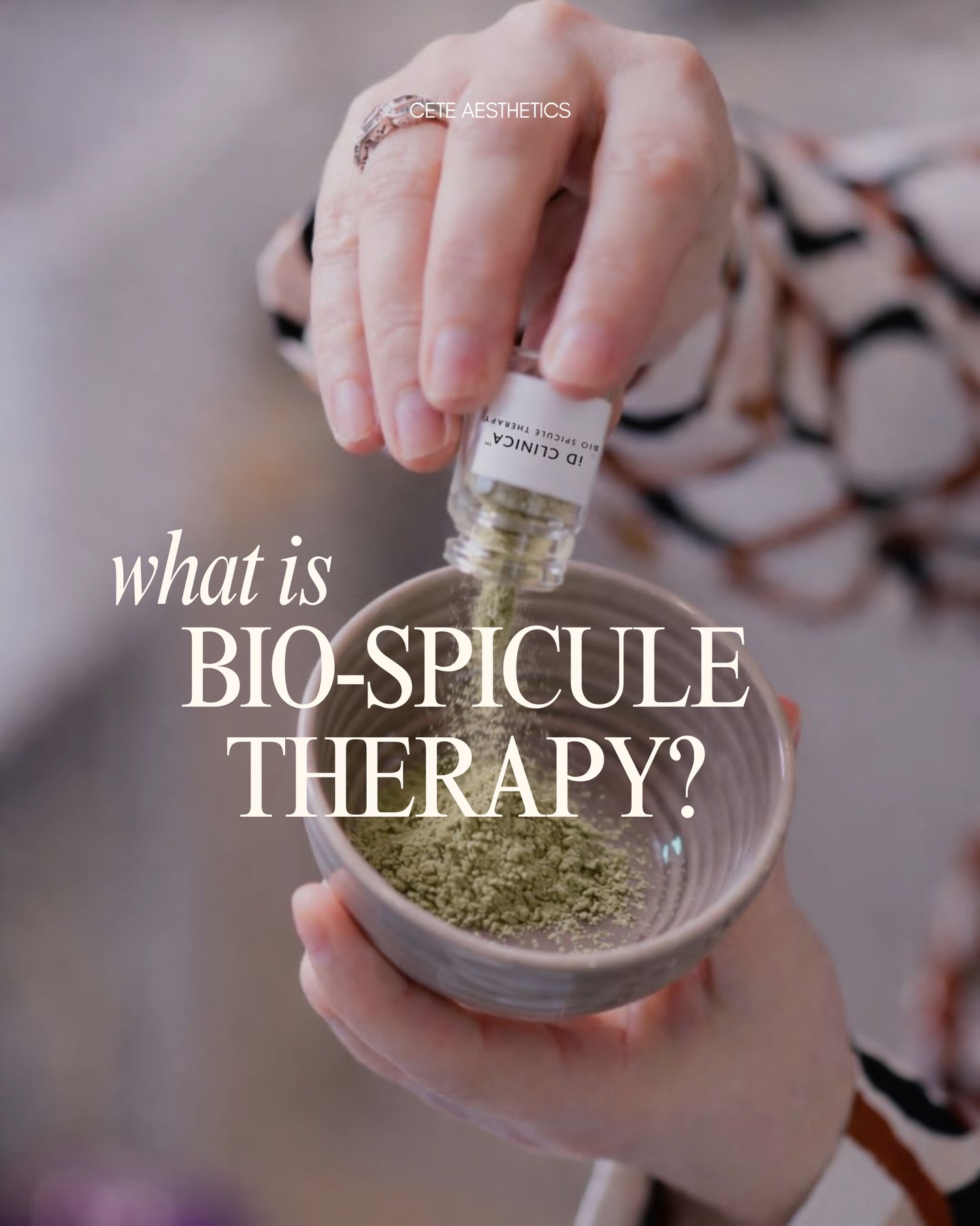 Bio Spicule Therapy at CeTe Aesthetics 🌱🫧
This is an advanced skin regeneration treatment designed to stimulate collagen, refine texture, and improve overall skin quality at a deeper level.
Often considered the equivalent of three microneedling treatments in just one session, it delivers powerful, visible results with minimal downtime.
✔️ Stimulates collagen and elastin
✔️ Improves acne outbreaks, scarring and skin texture
✔️ Brightens dull, tired skin
✔️ Softens fine lines
✔️ Reduces the appearance of pigmentation
You may feel the spicules working within the skin for up to 72 hours post-treatment – a key part of the regeneration process.
Peeling may occur in the days following the treatment.
If you’re looking for results-driven skin treatments rather than maintenance facials, this is for you.
Available to book under our ‘facials’ category on our website at www.ceteaesthetics.co.uk
——
#biospicule #skinregeneration #idclinica #scunthorpeaesthetics #medicalaesthetics