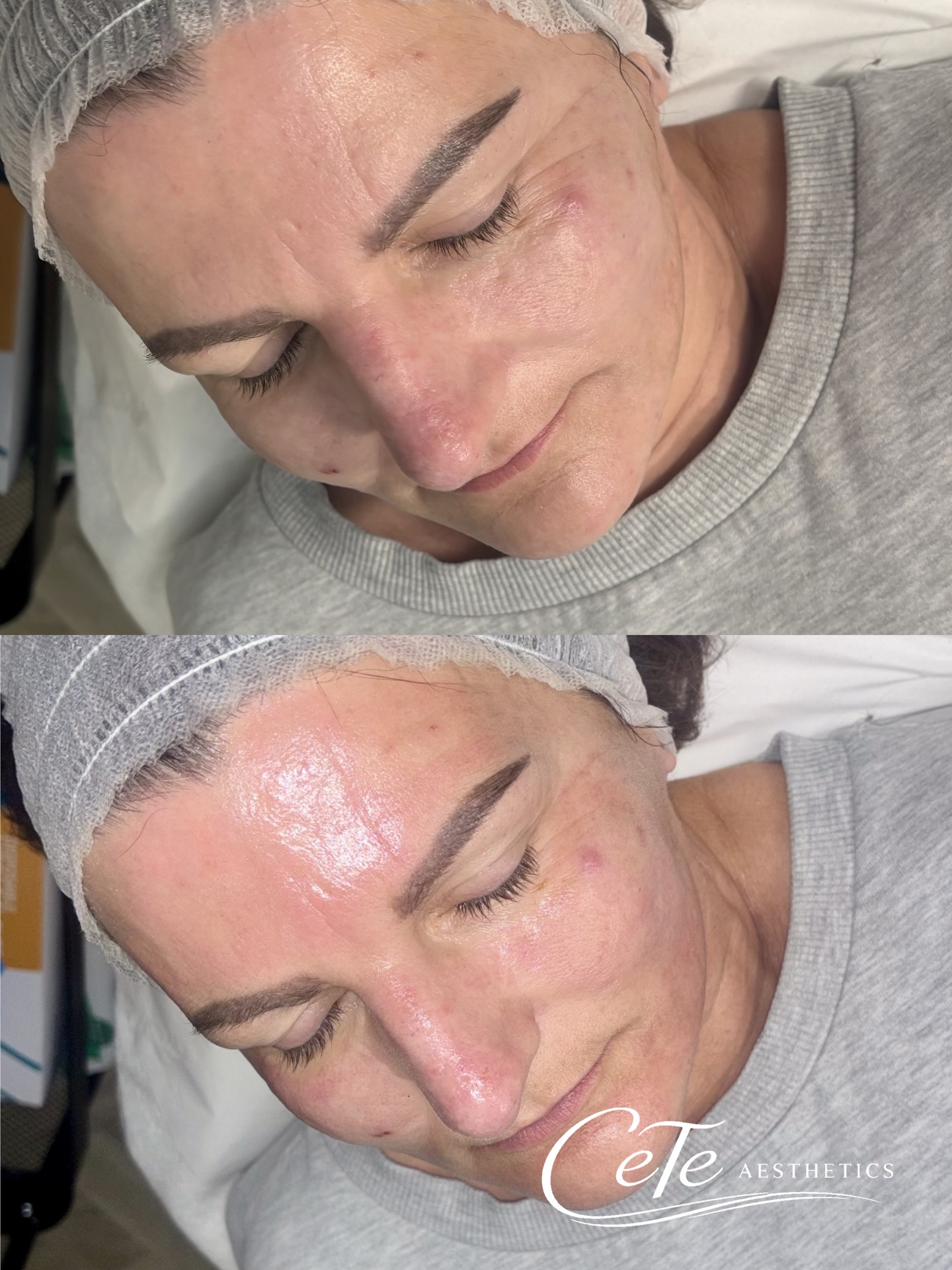 Microneedling is more than just collagen stimulation, it’s about delivering the right ingredients into the skin where they can actually work 🫧
During treatment, we used powerful skin-revitalising products containing a blend of hyaluronic acid, essential vitamins, amino acids, coenzymes and antioxidants.
These ingredients work together to:
• Deeply hydrate and improve skin elasticity
• Support collagen and elastin production
• Strengthen the skin barrier
• Improve dullness and uneven texture
• Help reduce the appearance of fine lines
By creating controlled micro-channels in the skin, microneedling allows these active ingredients to penetrate deeper, enhancing their effectiveness and delivering visible, long-term skin improvement.
This isn’t just a facial, it’s a regenerative treatment designed to restore skin quality from within.
——
#skinregeneration #microneedling #facialscunthorpe #medicalfacials #skintreatment