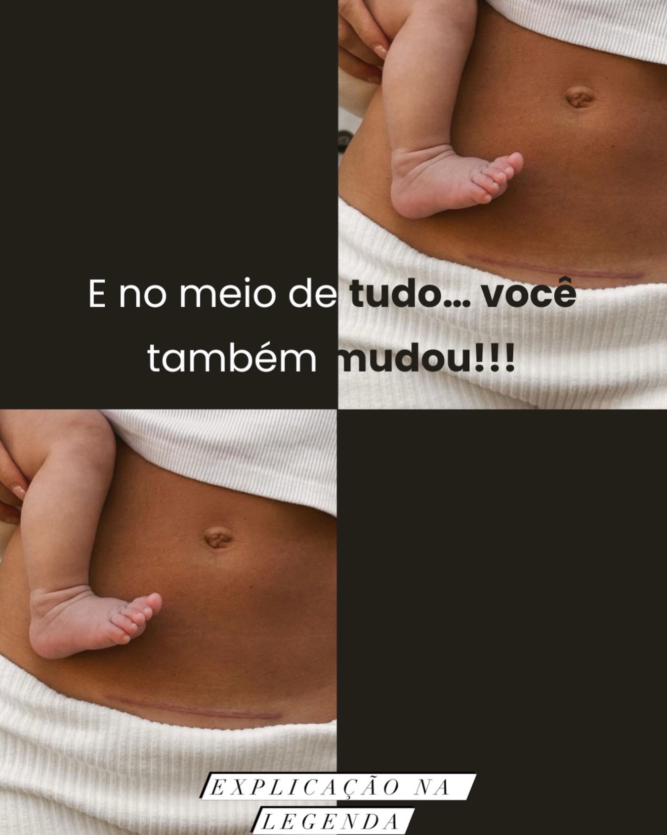 No meio de tudo… você também mudou.
E não só por fora!
Seu corpo se reorganizou, se adaptou, se transformou.
Mas, no meio da nova rotina, das noites mal dormidas e de toda atenção voltada para o bebê…
é muito comum que você se deixe para depois.
** E é aí que começam os silêncios:
aquela perda de urina que você releva,
o desconforto que você ignora,
a diástase que você não entende,
a cicatriz que ainda repuxa ou incomoda…
E a sensação de que “uma hora melhora”.
Mas o seu corpo continua ali, pedindo cuidado!!!
Porque o abdômen não trabalha sozinho.
Ele depende de uma base.
E essa base é o seu assoalho pélvico.
❤️ É o que sustenta tudo o que você vive hoje. 🤍