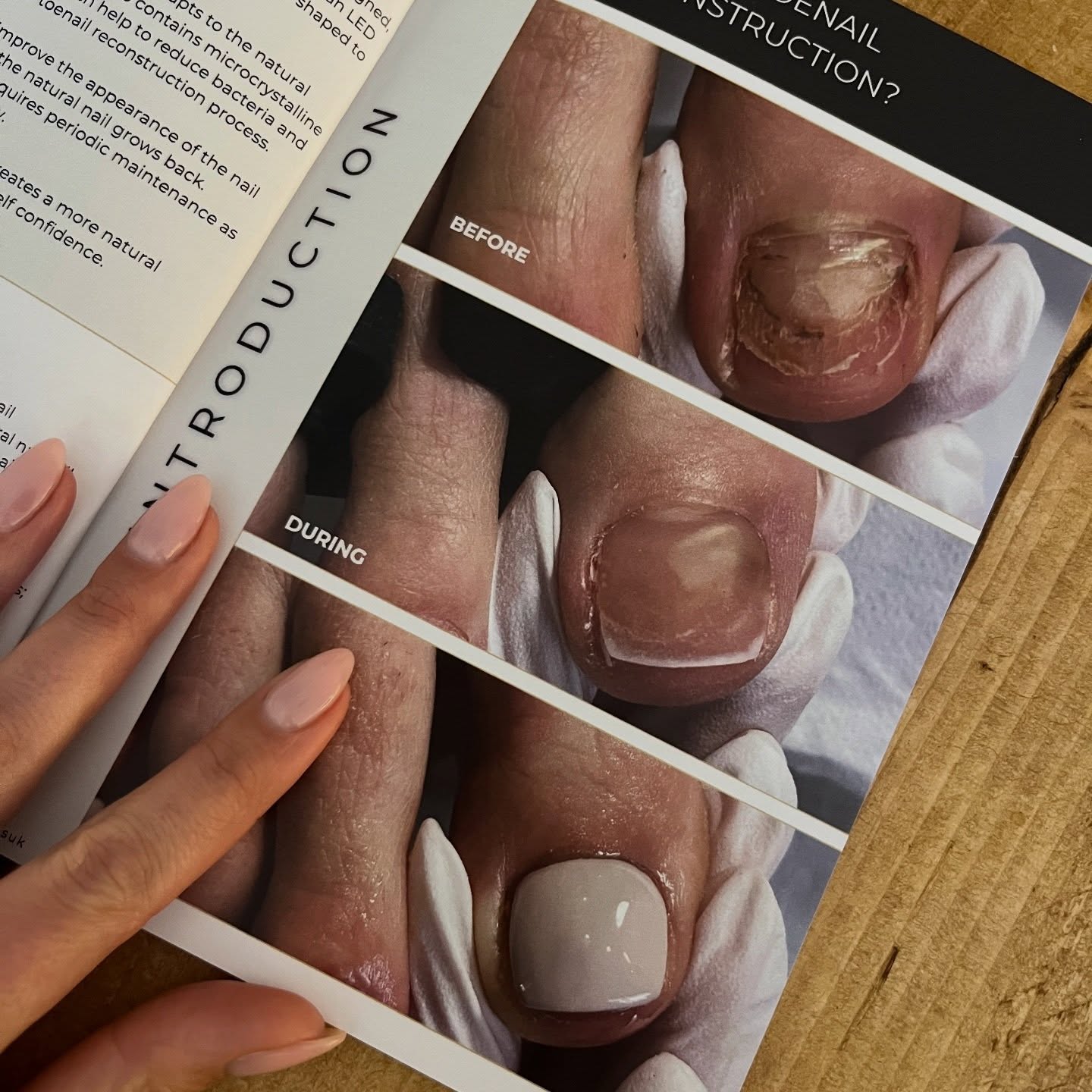 Toenail Reconstruction 👣
A specialist treatment used to rebuild the appearance of damaged or missing nails using advanced techniques and tailored shaping.
Results are natural, breathable, and designed to blend seamlessly.
It’s a highly specialised service, and not something widely offered in London — which is why we’ve made it part of our expertise at The Glow Bar.
#TheGlowBarLDN #ToenailReconstruction #BeforeAndAfter #FootHealth #LondonBeauty