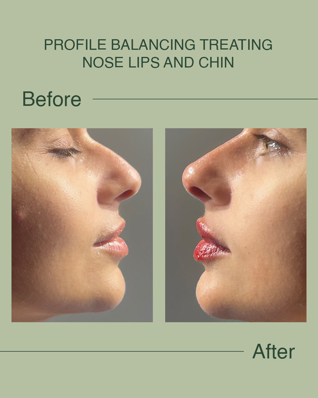 Sometimes it’s not about bigger lips…
It’s about balance.
#skincaretips #acnehelp #healthyskinjourney #skinfromwithin #clearskinhabits #skinawareness