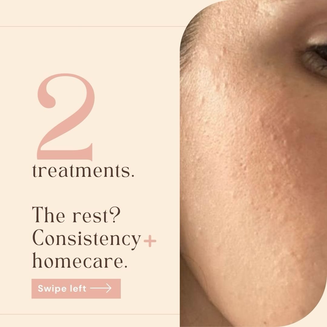 CLIENT RESULTS
Patience & consistency in action
Swipe for the after
This message from my client made my day!
She sent me these comparison photos white a very excited voice note (needed a x1.5 slow down option on WhatsApp 😂)
“But wow, wow, wow. Trust the process. Patience, consistency. I’m so happy. I wanted to share it with you.”
And this is EXACTLY why I always talk about the long game. No real results are quick, not when it comes to loosing weight, not when it comes to healing your gut, not when it comes to getting fit, not when it comes to getting rich, and not when it comes to microsoft updates 😂
AND
not when it comes to skin results!!
This clients results were achieved through consistent homecare, patience (believe me had to sometimes encourage the patience) , and trusting the process! She checked in with me often, car selfies, voice notes…
Skin 👏doesn’t 👏change 👏overnight 👏
Congestion, texture and “bumps” take time to normalise because we’re literally teaching the skin to behave differently.
This is why:
-quick fixes fail
-random product hopping fails
-patience + guidance works
Having someone in your corner to adjust your routine as your skin changes makes a huge difference — especially when you don’t live nearby and treatments aren’t frequent.
Your skin is not stuck:
It just needs the right plan + time to respond.
Consistency really does win 🫶
Side note:
I don’t often share before & after photos because it can make people compare and skincare is not one-size-fits-all.
What worked for this client won’t happen in the exact same way or timeline for someone else.
Our skin differs in:
• skin type & skin cycle
• genetics & hormones
• overall health & inflammation
• stress, sleep & exercise
• sun exposure & age
• medications, supplements & deficiencies
• alcohol & caffeine habits
And, and, and…
You get the idea…
Your skin journey is your own. Please don’t compare your timeline to someone else’s.
#skinresults #consistancy #patience #skincarejourney #somersetwest