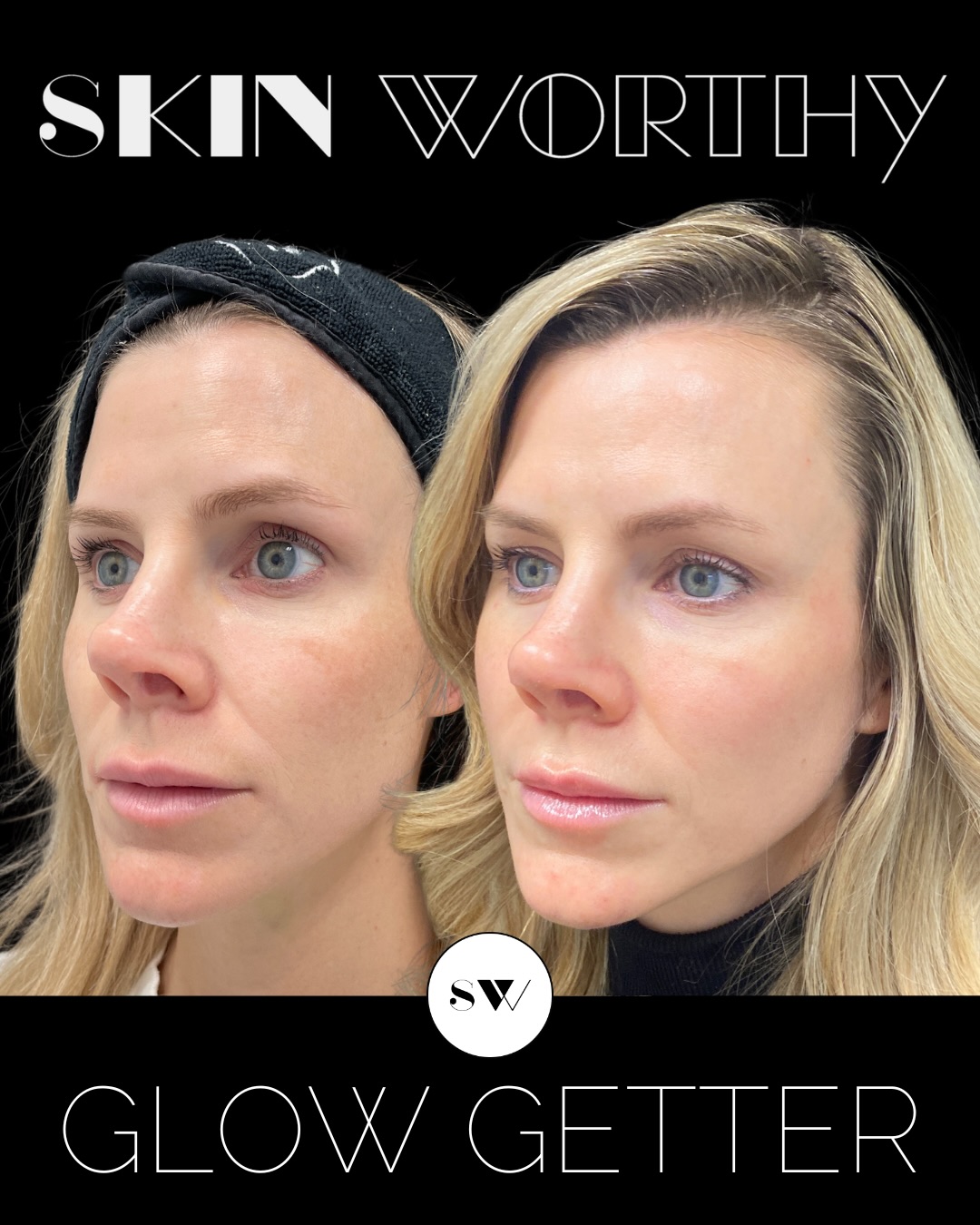 Spring is one of the best times to hit reset on your skin and get glowing for summer ✨
Sun damage? Pigment? Large pores? Dull skin? The #GlowGetter combination treatment is our most popular annual resurfacing treatment for a reason — it clears unwanted pigment, refines texture, and brings dull skin back to life.
Not only does it smooth and brighten for that airbrushed look, it also stimulates collagen to keep your skin strong, healthy, and radiant long-term.
For a limited time — until April 30 — receive a complimentary VAMP application ($300 value) to speed up healing and enhance your results.
Call/text 647-350-7546 or visit skinworthy.ca to get your best skin in time for summer ☀️