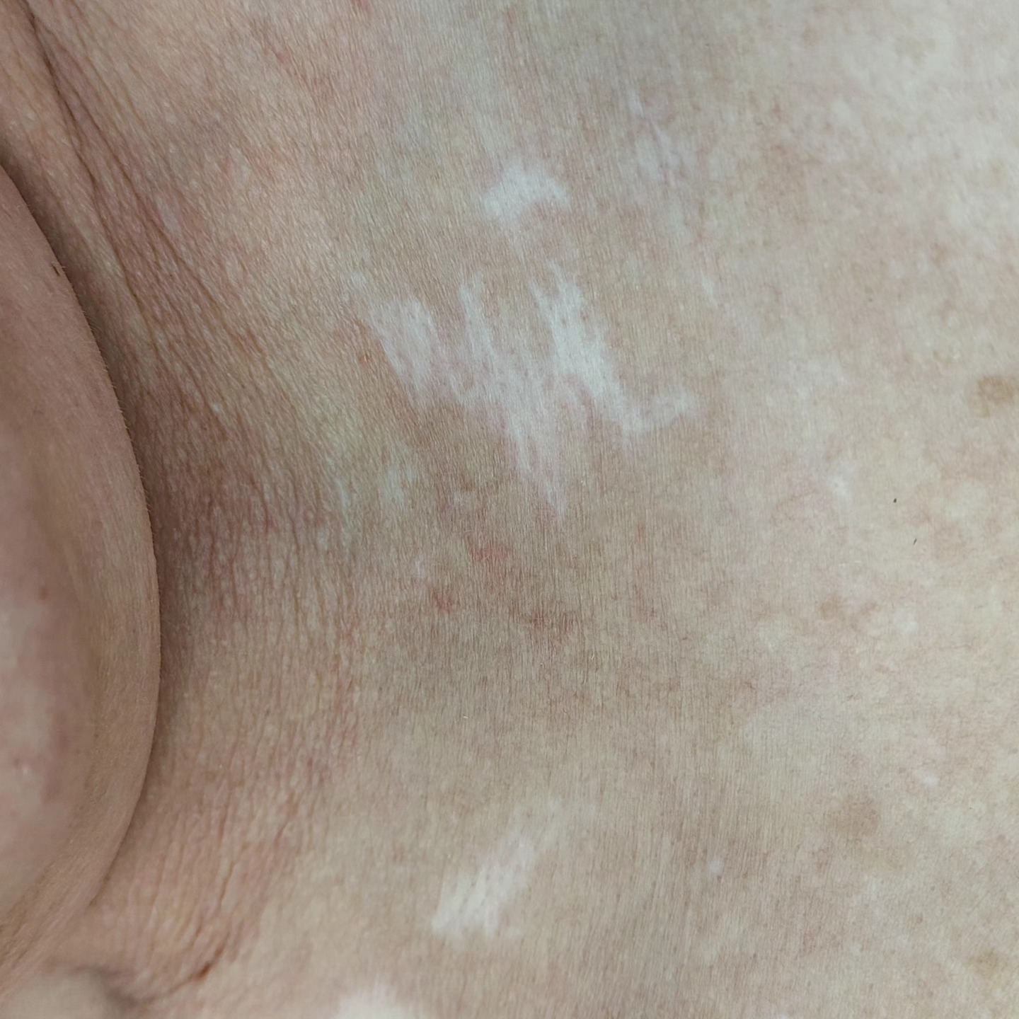 Cosmetische tattoo - litteken camouflage.
Op de eerste foto zoals het litteken was en op de tweede foto na één behandeling het gewenste resultaat. Op de laatste foto gelijk na de 2e behandeling, ziet er heftig uit maar heeft even de tijd nodig om te genezen en naar het gewenste resultaat te komen.
#littekens #pmu #tattoo #camouflaged #cosmetischetattoo