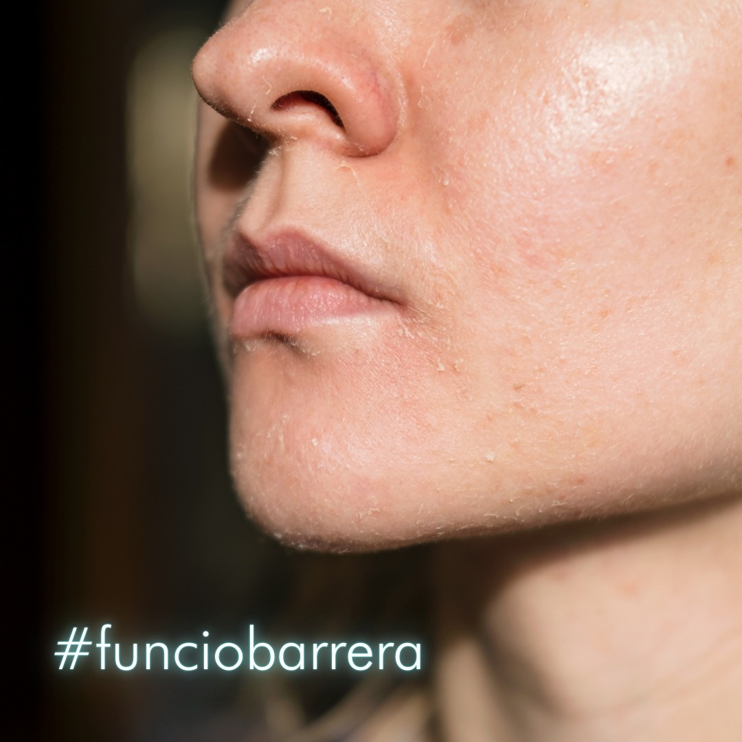 |DERMATOLOGIA|
La funció barrera és el sistema de defensa natural de la teva pell.
Està en la capa més superficial (epidermis) i actua com un “escut intel·ligent”.
Per a què serveix?
Evita la pèrdua d'aigua (deshidratació)
Protegeix enfront d'agressions externes (fred, contaminació, bacteris)
Manté l'equilibri i la salut cutània
Senyals de barrera danyada:
Tibantor constant
Enrogiment
Sensibilitat o coïssor
Brots d'acne o dermatitis
Pell apagada
Com cuidar-la:
Neteja suau (sense agressió)
Hidratants amb ceramides i niacinamida
Evitar excés d'àcids o retinol sense control
Protecció solar diària