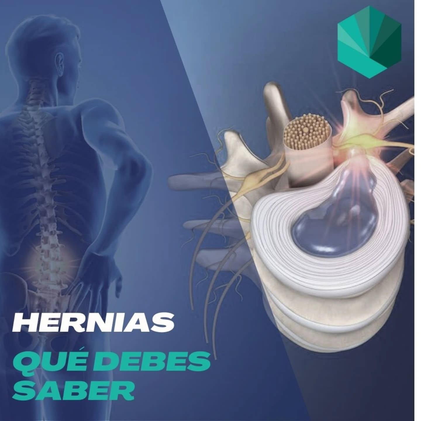 🌟 ¡Hablemos de las hernias discales! 🌟
¿Sabías que tu columna vertebral también puede tener días difíciles? 😅 Las hernias discales son como esos amigos que se cuelan en la fiesta y no saben cuándo irse. Cuando el disco intervertebral decide hacer un "desplazamiento" y presiona los nervios, ¡puede causar un verdadero caos! 🎉
🔍 ¿Qué señales te envía tu cuerpo?
- Dolor en la espalda baja o cuello (¡ay, eso no es divertido!)
- Dolor que se escapa hacia las piernas o brazos (¡no, gracias!)
- Debilidad muscular o entumecimiento (¡no queremos ser un espagueti!)
- Dificultad para moverse (¡como un robot oxidado!)
💪 ¿Cómo puede la fisioterapia salvar el día?
¡Aquí es donde entramos nosotros! 🦸♂️ La fisioterapia es como el superhéroe de tu columna. Con ejercicios específicos, técnicas de movilización y un poco de magia (ok, es ciencia), podemos ayudarte a:
- Decirle adiós al dolor 👋
- Moverse como si estuvieras en una pista de baile 💃🕺
- Fortalecer esos músculos que sostienen tu columna (¡esos músculos son los verdaderos MVP!
- Prevenir que las hernias vuelvan a hacer de las suyas 🚫
Recuerda, cada columna tiene su propia historia. Si sientes que una hernia discal está tratando de robarte el show, ¡consulta a un profesional! Tu bienestar es la estrella del espectáculo. 🌟❤️