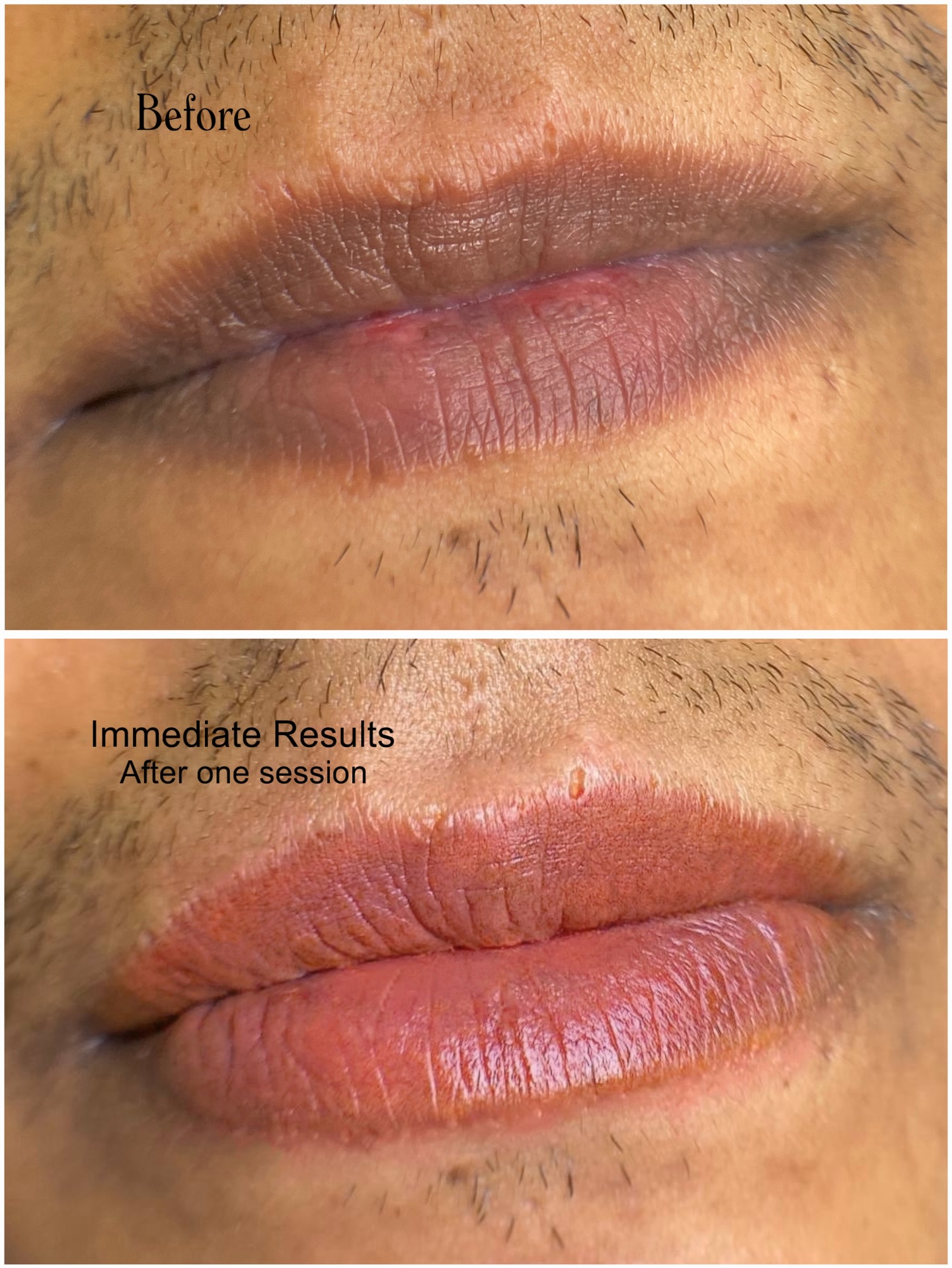 Lip neutralization for men & women ✨
Perfect for dark, purple, violet, brown or uneven lips.
This treatment gradually corrects and evens out the tone, revealing a more balanced and natural color over multiple sessions.
Patience is key to achieve beautiful, brighter results without darkness or opacity.
Ready to start your transformation? Book now through the link in my bio 💋
#pmu #darklipscorrection #darklips #darklipneutralization #cardiff