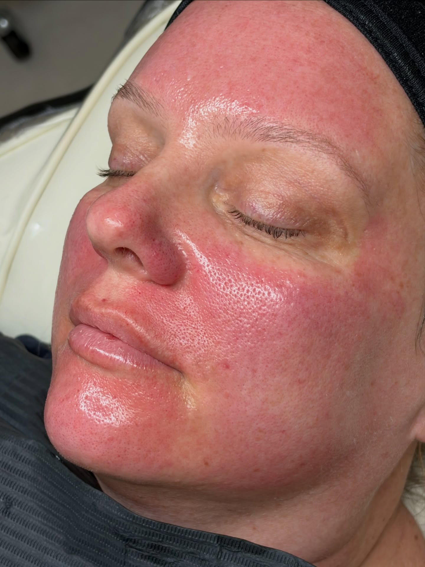 That after microneedling glow ✨
This is what controlled skin trauma looks like when it’s done properly.
Not filters.
Not makeup.
Not temporary.
This is your skin switching ON collagen production, increasing cell turnover, and rebuilding itself from within.
Most people are scared of redness…
But this is where the magic actually happens.
The truth?
The clients who trust the process always get the best results.
And once you’ve had skin like this… you don’t go back.
Limited appointments available this week.
Message me “GLOW” to book.