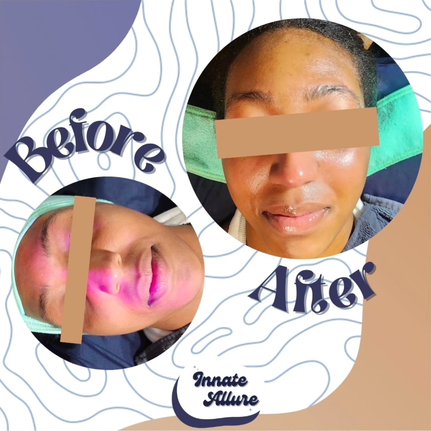 Real results from my customized Signature Facial ✨
For this client, we focused on rebalancing the skin and restoring a healthy, radiant complexion. When your skin is properly supported, it shows smoother texture, even tone, and that natural glow coming through.
Now the real work begins 💙 maintaining these results with a consistent homecare routine. Treatments set the foundation, but your daily habits are what keep the momentum going. Healthy skin is a journey, not a one-time fix.
#InnateAllure #ChicagoSkincareStudio #ChicagoFacial
#BlackEstheticianChicago #CustomizedSkincare