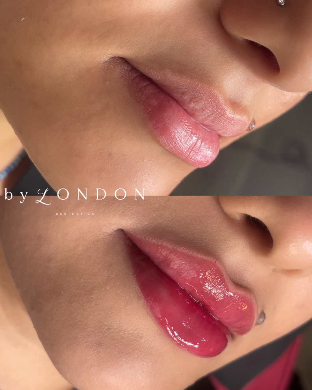 Shape and symmetry over basic volume, always 💁🏻♀️
𝗕 𝗬 𝗟 𝗢 𝗡 𝗗 𝗢 𝗡 𝗔 𝗘 𝗦 𝗧 𝗛 𝗘 𝗧 𝗜 𝗖 𝗦
📍 High Road, Wood Green, North London
▪️ Russian Lips
▪️ Full Facial Contouring + Balance
▪️ Liquid Rhinoplasty + Pixie Tip Lift
▪️ Skin Boosters, Polynucleotides + Exosomes
▪️ Anti Wrinkle Advanced
▪️ PDO Threads
📃 𝗖𝗣𝗗 𝗔𝗰𝗰𝗿𝗲𝗱𝗶𝘁𝗲𝗱 𝗧𝗿𝗮𝗶𝗻𝗶𝗻𝗴 𝗳𝗼𝗿 𝗔𝗲𝘀𝘁𝗵𝗲𝘁𝗶𝗰 𝗜𝗻𝗷𝗲𝗰𝘁𝗼𝗿𝘀
👩🏻🎓 Pathway & Beginners Packages
🥇 Advanced Level Masterclasses
💻 Online Courses available
📞 WhatsApp 07774 054 013
#russianlips #russianlipfiller #naturallips #naturallipfiller