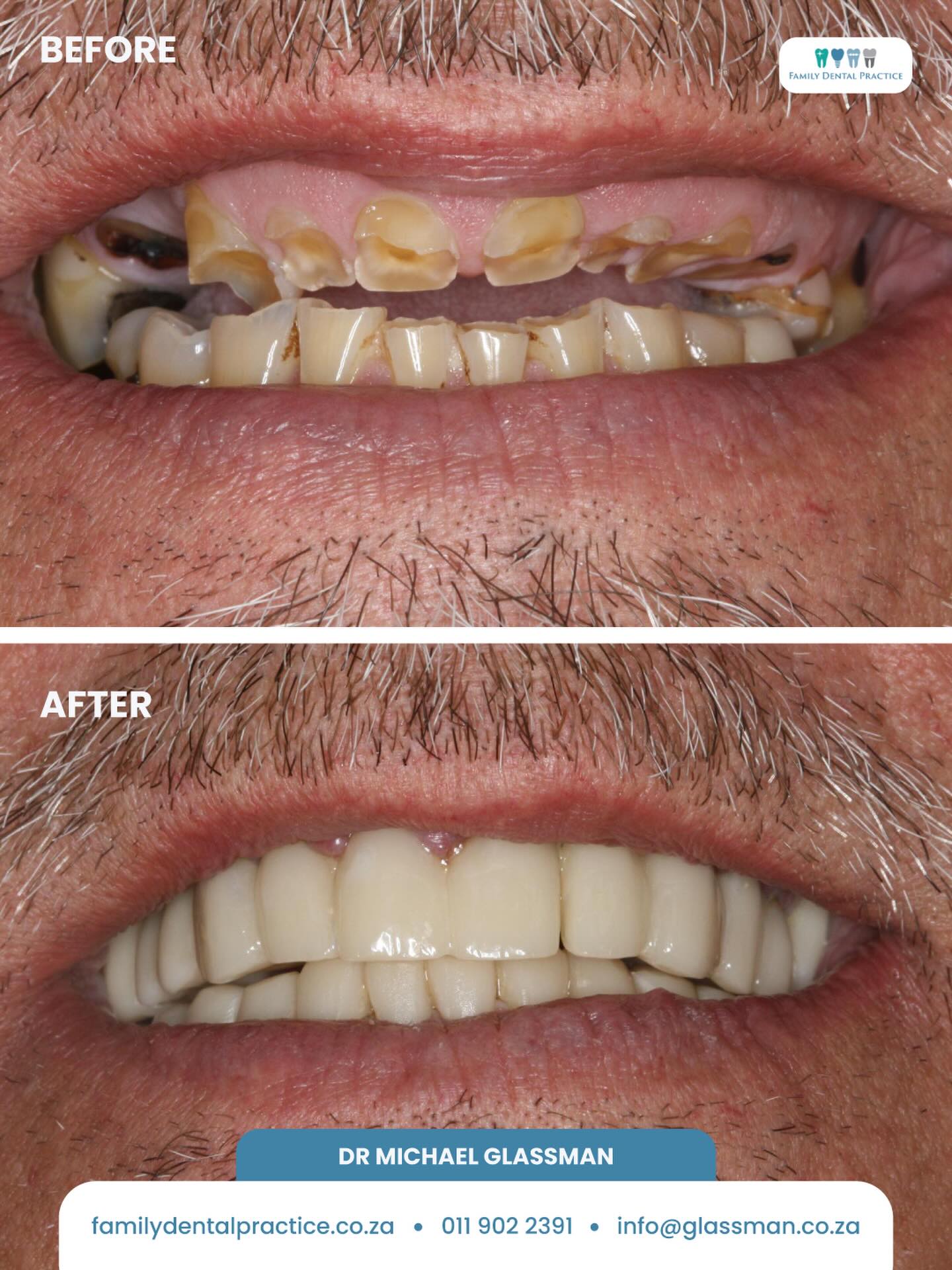 A smile transformation like this is about so much more than aesthetics.
With careful planning and expert treatment by Dr Michael Glassman, this patient’s smile was completely restored, improving function, comfort, and confidence in a truly life-changing way.
These kinds of cases remind us just how powerful dentistry can be when experience, precision, and patient care come together.
🌐 familydentalpractice.co.za
📞 011 902 2391
📧 info@glassman.co.za
#FamilyDentalPractice #SmileTransformation #BeforeAndAfter #DentalReconstruction #RestorativeDentistry