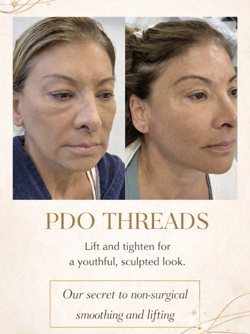 Lifted, sculpted, and naturally refreshed ✨
PDO Threads are the secret to a non-surgical lift—helping tighten, smooth, and redefine your features while boosting collagen from within. The result? A more youthful, contoured look without the downtime of surgery.
Subtle changes. Powerful results.
Procedure: Thread Lift to Face and Jowls
⏱Time: 60 min
🗓Duration: 10-12mos
💉Method: Lifting of fat pads/collagen builder/skin tightening
🪡Touch ups: Common if desire more lift or tightening
📌Note: If okay'd by your medical provider, avoid all blood thinners for 2 weeks before injections including: Ibuprofen, Excedrin, Aspirin, Aleve, Vitamin E, Fish oil, etc.
📍Advice: Avoid alcohol for 3 days prior to injections and avoid going to the dentist 2 weeks before & after injections.
🧴Comfort: Topical and/or local numbing.
⚠️Must be performed by an experienced injector.
📷Pics taken immediately after
🌡It’s common to bruise and swell. Tenderness/Tightness can last 2 wks. Dimpling may occur and will resolve in 2-3 wks
🩹Allow up to 1-2wks to heal
Call or text today to book your appointment!
☎️ 239-448-3383
📩 chris.jewell@jewellmedicalspa.com
🌐 www.jewellmedicalspa.com | www.mrinjectable.com
📍 1044 Castello Drive, Ste 213 Naples Florida 34103
💳 We Accept Care Credit!
*
*
*
#smooth #threads #skin #tightening #acne #scaring #injections #naples #naplesfl #naplesinjector #aesthetics #injectables #cosmeticinjectables #beforeandafter