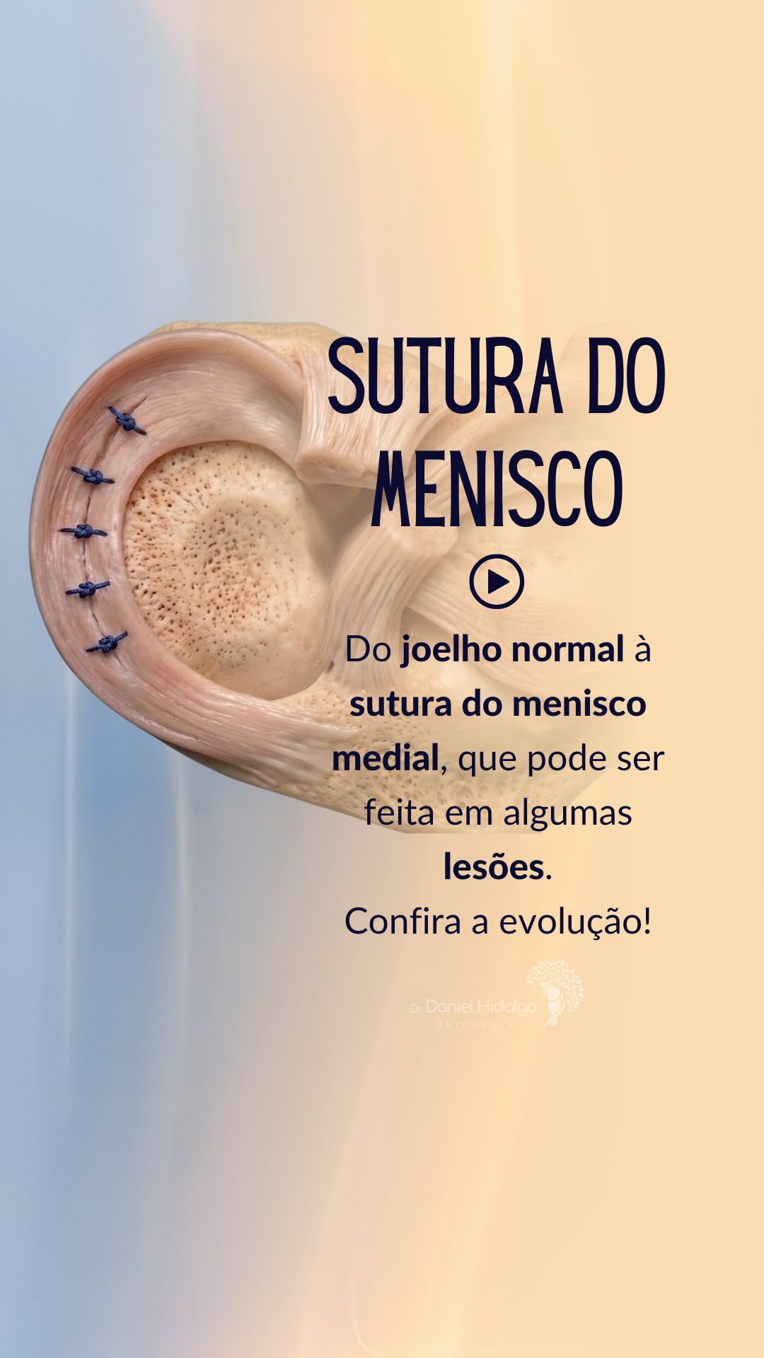 Do joelho saudável à lesão; e de volta à estabilidade. 🦵�Neste vídeo, você acompanha a evolução de um menisco medial normal, passando por uma lesão longitudinal e pelo tratamento com sutura, preservando a função e protegendo o joelho a longo prazo.�
Compartilhe com quem precisa entender melhor essa lesão!