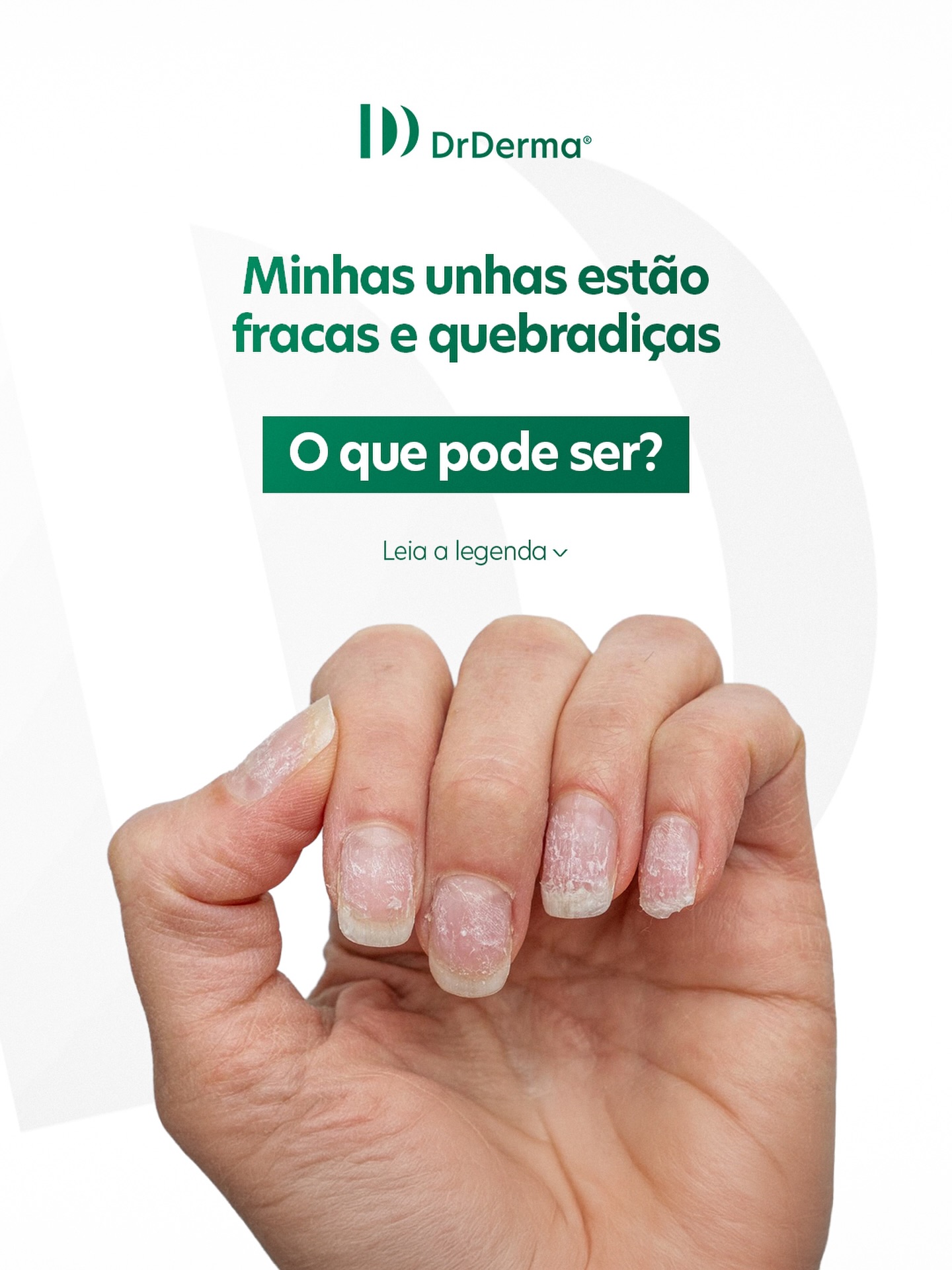 Unhas fracas, quebradiças ou com alterações de cor podem indicar infecções, deficiências nutricionais ou problemas dermatológicos.
Evitar retirar excessivamente as cutículas, manter a hidratação das mãos e observar mudanças nas unhas são cuidados importantes.
Se as alterações persistirem, a avaliação com dermatologista é essencial para identificar a causa.
👉 Consulte um dermatologista pelo site www.drderma.com,br no link da BIO!
