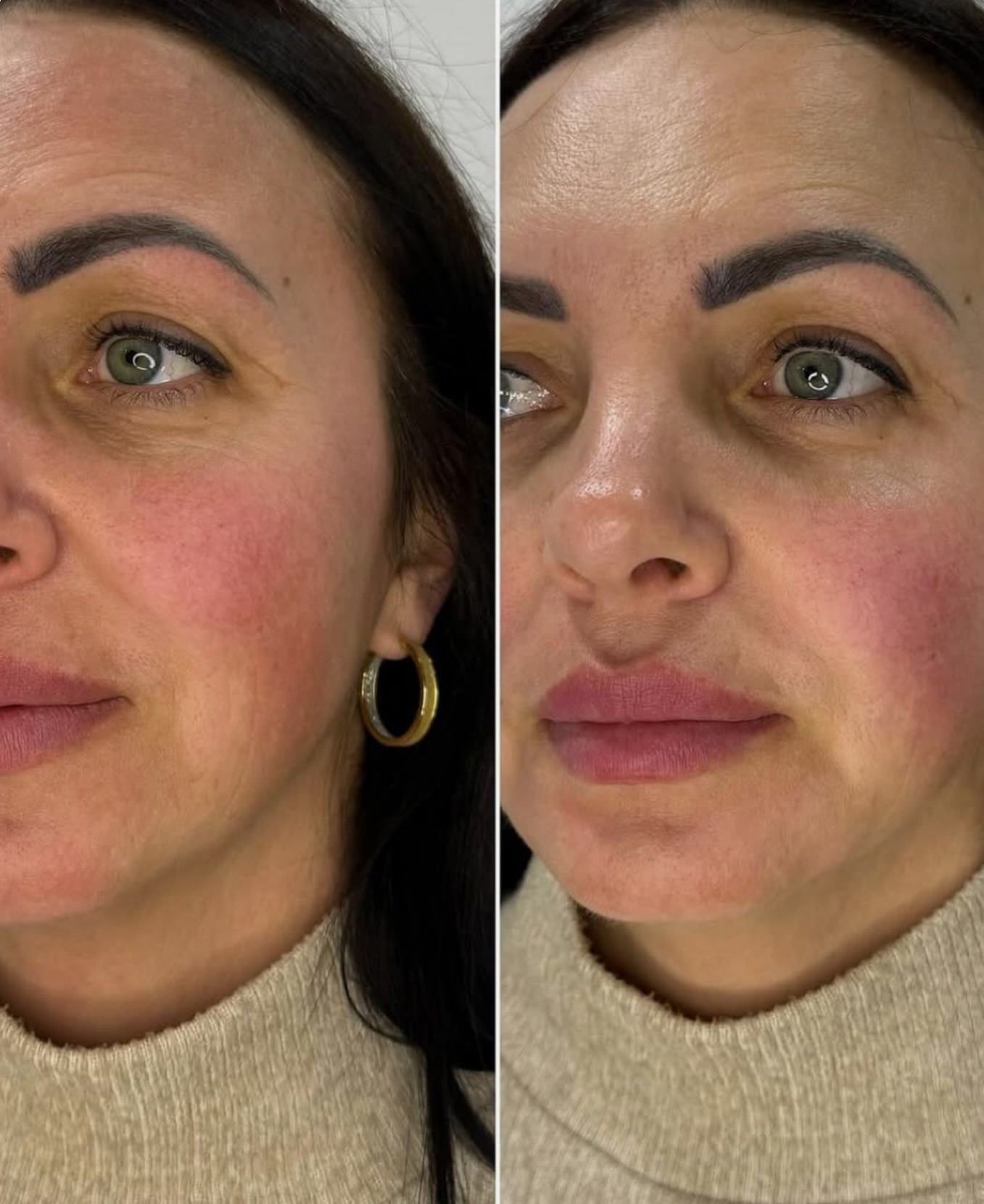 ✨ PLLA Skin Booster with Juvelook ✨
Natural results. No overfilling. Just better skin.
Juvelook combines PLLA (collagen stimulator) with hyaluronic acid to improve your skin from within — not change your face.
💉 Stimulates your own collagen
💉 Smooths fine lines & improves texture
💉 Refines pores & boosts elasticity
💉 Gives a fresh, healthy glow
This is skin regeneration, not volume — results build gradually and look completely natural.
💰 Face: €390
📩 Book your consultation
📍 Priory Medical #pllaireland #skinbooster #skinrejuvenation