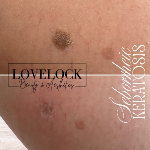 Seborrheic Keratosis Straight after procedure
Key Facts About Seborrheic Keratosis
Not Cancerous: SKs are not skin cancer, nor do they turn into it.
Appearance: They can be smooth or rough, waxy, and range in color from light tan to black. They often look as if they were “pasted” or “stuck” onto the skin.
Location: Common on the face, neck, chest, and back; they do not appear on palms or soles.
Symptoms: Generally asymptomatic, but can itch, become inflamed, or bleed if irritated by clothing.
Causes: The exact cause is unknown, but they are strongly linked to aging, genetics, and potentially sun exposure.
Treatment: these can easily be removed using a plasma pen.
#warminster #trowbridge #melksham #westbury #bradfordonavon
