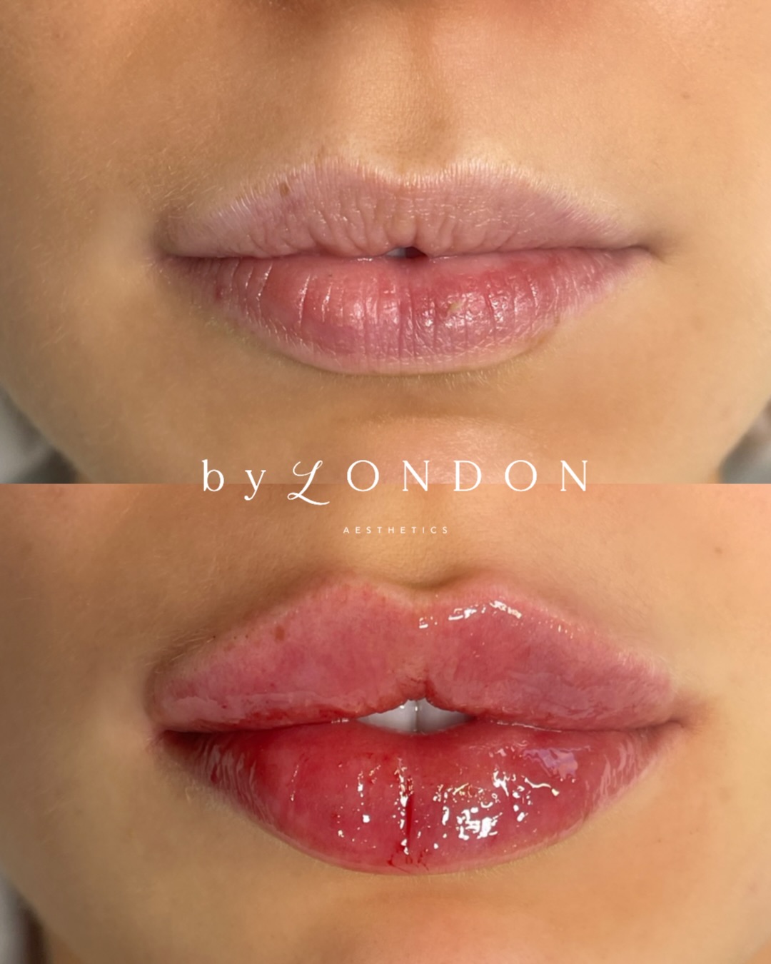 True heart shaped Russian Lips with a keyhole pout 🔑
𝗕 𝗬 𝗟 𝗢 𝗡 𝗗 𝗢 𝗡 𝗔 𝗘 𝗦 𝗧 𝗛 𝗘 𝗧 𝗜 𝗖 𝗦
📍 High Road, Wood Green, North London
▪️ Russian Lips
▪️ Full Facial Contouring + Balance
▪️ Liquid Rhinoplasty + Pixie Tip Lift
▪️ Skin Boosters, Polynucleotides + Exosomes
▪️ Anti Wrinkle Advanced
▪️ PDO Threads
📃 𝗖𝗣𝗗 𝗔𝗰𝗰𝗿𝗲𝗱𝗶𝘁𝗲𝗱 𝗧𝗿𝗮𝗶𝗻𝗶𝗻𝗴 𝗳𝗼𝗿 𝗔𝗲𝘀𝘁𝗵𝗲𝘁𝗶𝗰 𝗜𝗻𝗷𝗲𝗰𝘁𝗼𝗿𝘀
👩🏻🎓 Pathway & Beginners Packages
🥇 Advanced Level Masterclasses
💻 Online Courses available
📞 WhatsApp 07774 054 013