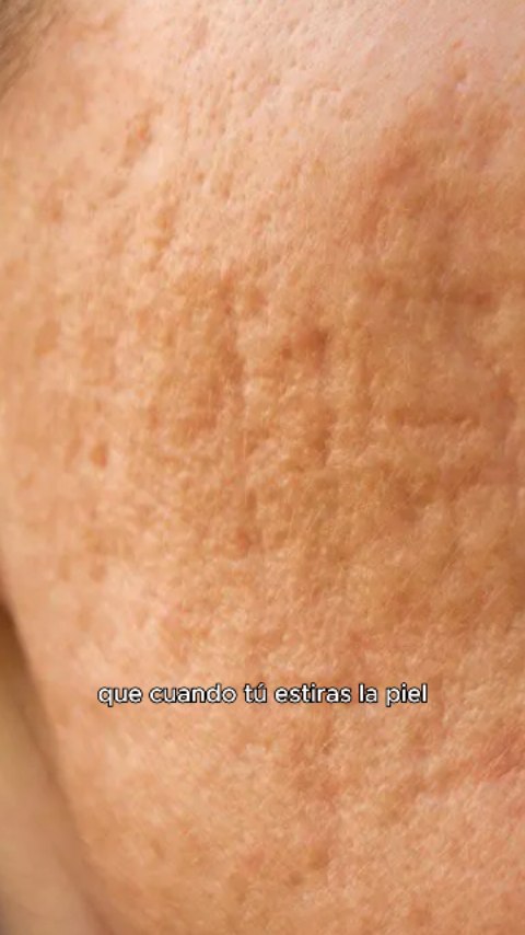 Las cicatrices de acné no son todas iguales.
Tienen características distintas y, por lo tanto, un manejo específico.
🩺La valoración dermatológica es clave para elegir el tratamiento adecuado.
#CicatricesDeAcné #Dermatología #Acné #Dermatólogo