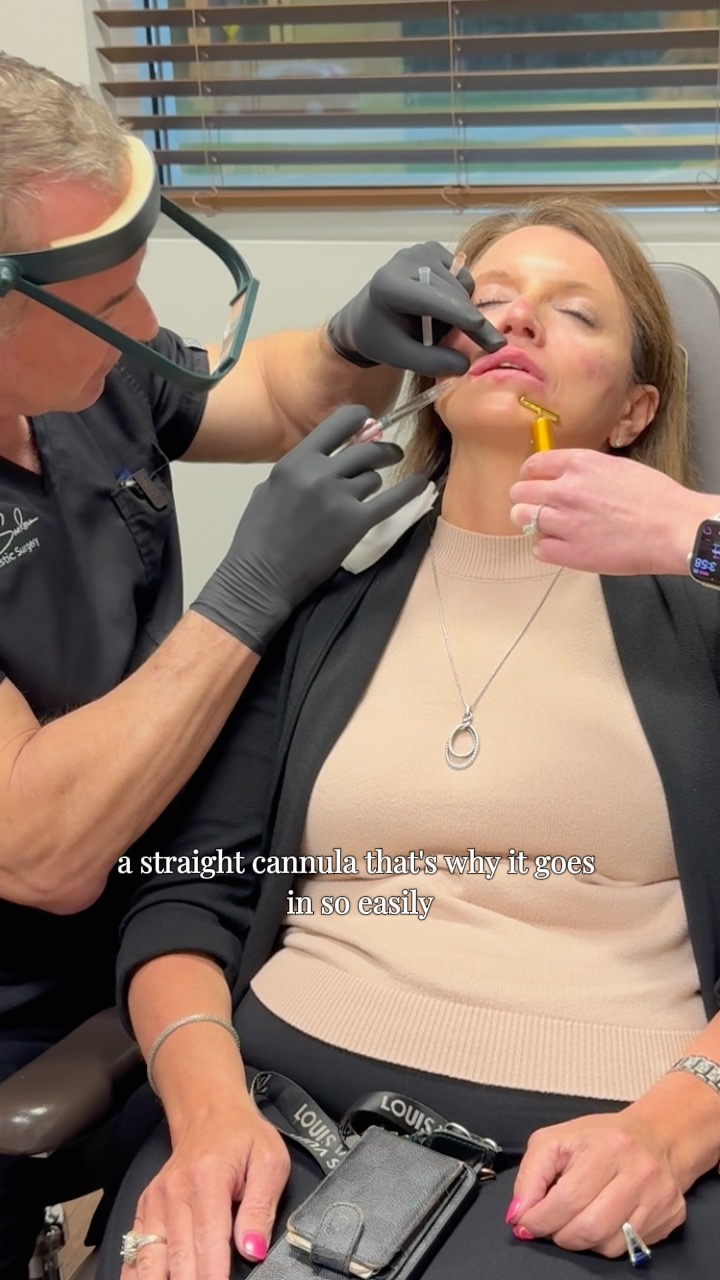 One of the reasons our lip filler appointments feel so smooth? The cannula technique đ
Dr. Kenneth Sanders uses the cannula technique to keep things smooth, controlled, and way more comfortable.
Instead of multiple needle injections, a small entry point is made, and the cannula gently glides between the skin and the muscle to place filler evenly with less disruption.
Translation: less bruising, less swelling, and an appointment that feels a lot easier than you probably expected. Most people are surprised by how quickly theyâre back to their day after.
Itâs one of those small details that makes a big difference in both your experience and your results.
If youâve been thinking about lip filler in Shreveport, this is your sign.
Call (318) 698-8711 to schedule.
#LipFillerShreveport #CannulaTechnique #JuvedermShreveport #DrKennethSanders #ShreveportMedspa