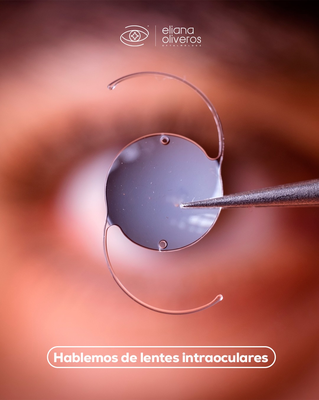 Elegir la opción correcta es el primer paso para cambiar tu forma de ver el mundo. ✨
Hoy quiero hablarte de los lentes intraoculares, una excelente alternativa si tienes cataratas o necesitas correcciones visuales específicas.
⬇️¿Por qué son una gran opción?
✔️ Mejoran significativamente la calidad de tu visión.
✔️ Se personalizan según las necesidades de tus ojos.
✔️ Se adaptan a tu estilo de vida para darte mayor libertad.
No hay una fórmula única, pero la clave del éxito está en una valoración oftalmológica adecuada. 👁️👩🏻⚕️
¿Tienes dudas sobre este tratamiento? ¡Déjamelas en los comentarios o envíame un DM para agendar tu cita de valoración! 👇🏼