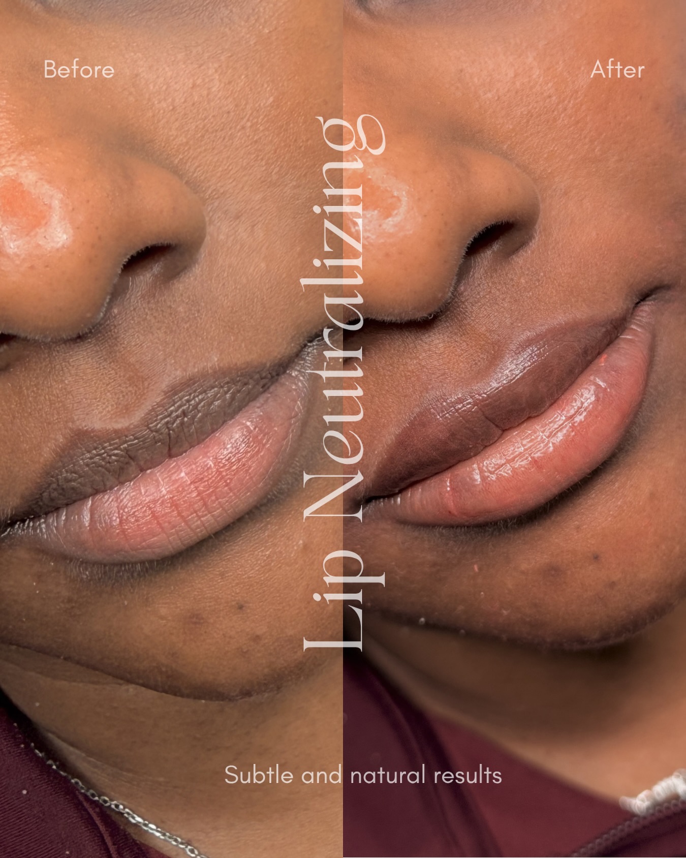 Lip neutralizing is one of my favourite procedure to do because it’s the most subtle natural instant result and having you guys trust me for this big decision in your life to be able to help you with your insecurities is a blessing.
#lipneutralization #lipneutralizing #torontolipneutralization #torontobeauty