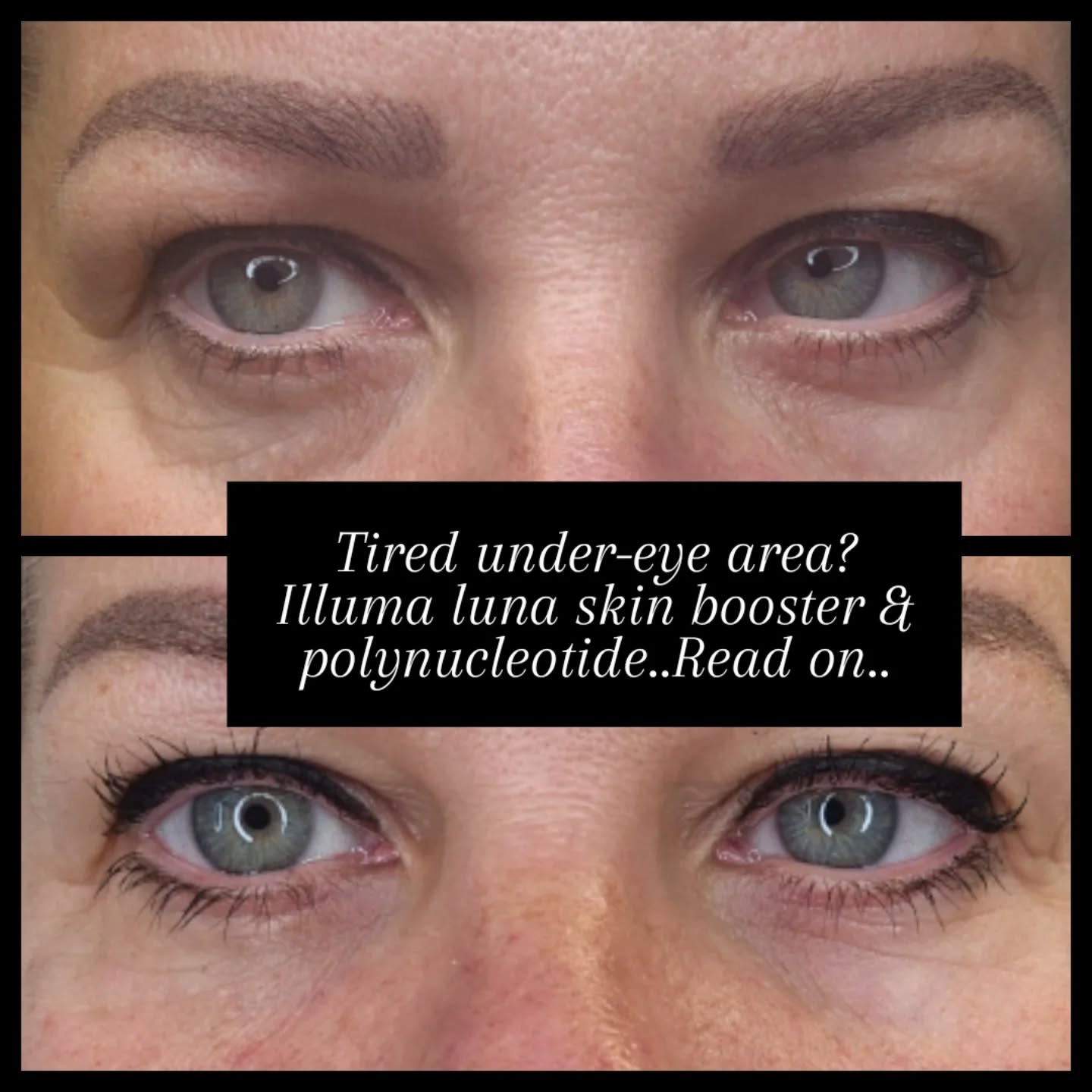 Tired, hollow under-eyes? This is your sign ✨
I’ve been treating the under-eye area using Illuma Luna — a next-generation skin booster combining polynucleotides + hyaluronic acid + three targeted peptides for real skin regeneration, not just temporary results.
This treatment is designed to:
• Brighten dark circles and pigmentation
• Plump and soften hollow tear troughs
• Smooth fine lines and crepey skin
• Deeply hydrate and improve overall skin quality
What’s inside?
Illuma Luna is a polynucleotide-based skin booster, meaning it works at a cellular level to repair and regenerate the skin. It also contains:
• Hyaluronic acid for deep, long-lasting hydration
• 3 peptides (Pentapeptide-13, Tripeptide-29 & Dipeptide-2) to support collagen production, improve elasticity, and strengthen the delicate under-eye skin
The combination helps stimulate collagen, improve skin structure, and restore a brighter, smoother, more refreshed under-eye appearance — without adding volume like filler.
Natural, regenerative, and subtle… just how it should be ✨
DM to book or learn more 💌