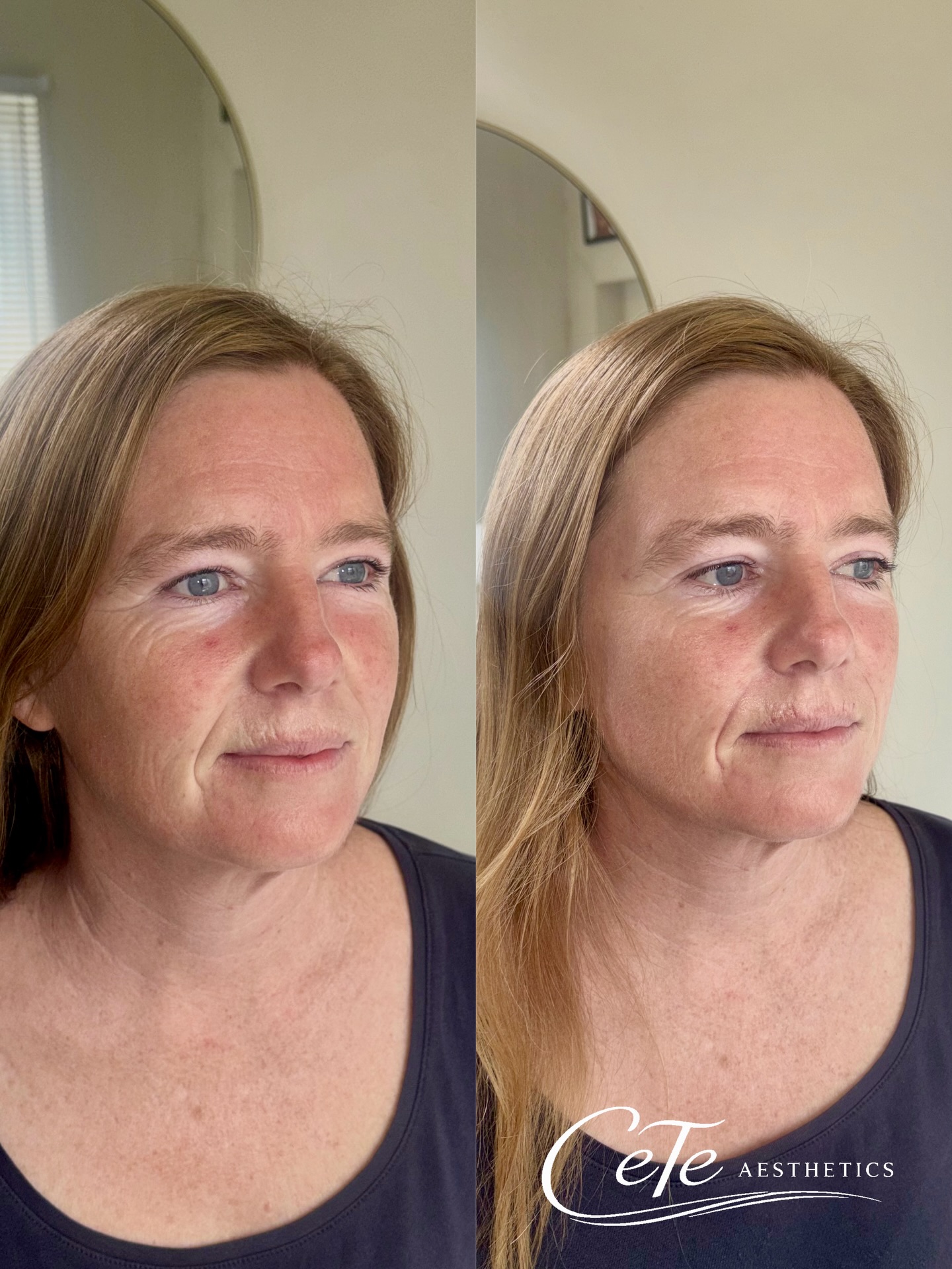 Subtle, strategic and tailored 💉
This isn’t about changing a face, it’s about restoring what time has softened.
Softening of lines, gentle support through key areas, and a refreshed overall appearance… without looking “done.”
Please book ahead as we are very busy in clinic and unable to fit clients in last minute
For new treatment bookings please visit www.ceteaesthetics.co.uk
——
#dermalfillertraining #aesthetics #nurseaesthetics #scunthorpebusiness #lincolnshirebusiness