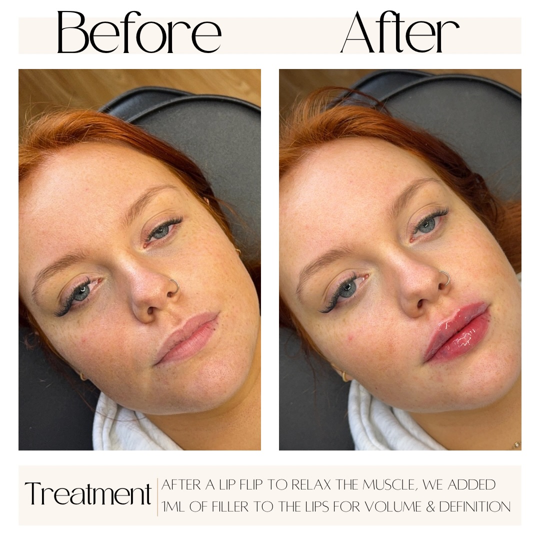 Before -
16 days post Lip Flip which had previously been done in clinic to help relax the muscle in the lip. We chose to do this as when the client smiled her lip was hidden due to the strength of her muscle.
After -
We placed 1ml of RHA2 by @teoxane_uk in the lips to add volume, definition and enhance our clients gorgeous shape. Bruising and swelling is present but will settle within a week with the correct aftercare.
Results are natural yet effective - the way we like it here💉👄
#lipflip #lipfiller #aestheticspractioner #sunderlandaesthetics
