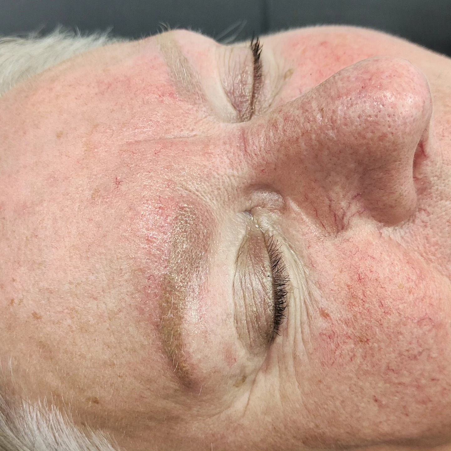 Anti grijs behandeling door middel van het laseren van de wenkbrauwen. Over 6 weken is de huid volledig genezen en kunnen er mooie passende wenkbrauwen overheen zetten. De huid lijkt nu nog wat geel van kleur maar dit trekt vandaag/morgen weg.
Wil jij ook van slecht gezette pmu of tattoo af? Vraag naar de mogelijkheden. Dit kan al vanaf 45 euro per behandeling.
#tattooverwijdering #laseren #antigrijswenkbrauwen #permanentmakeup #wolvega #bolsward #heerenveen #friesland #overijssel #steenwijk #beauty #beautysalon #wenkiesonfleek #wenkbrauwspecialist