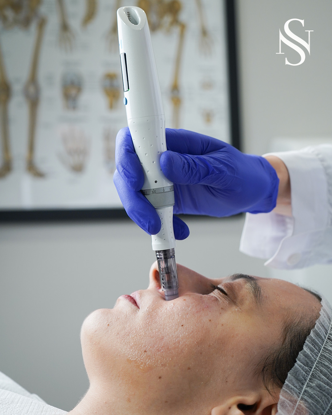 This is where real skin work happens.
No filters, no quick fixes… just treatments that actually improve your skin over time.
Microneedling helps stimulate collagen, smooth texture, and bring your skin back to life in a natural way.
It’s not about instant perfection
It’s about long-term, healthy results.
If your skin feels dull, uneven, or just not like it used to…
This is one of the treatments that truly makes a difference 🤍
Book your free consultation and let’s see what your skin actually needs.
#skincaretips #acnehelp #healthyskinjourney #skinfromwithin #clearskinhabits #skinawareness