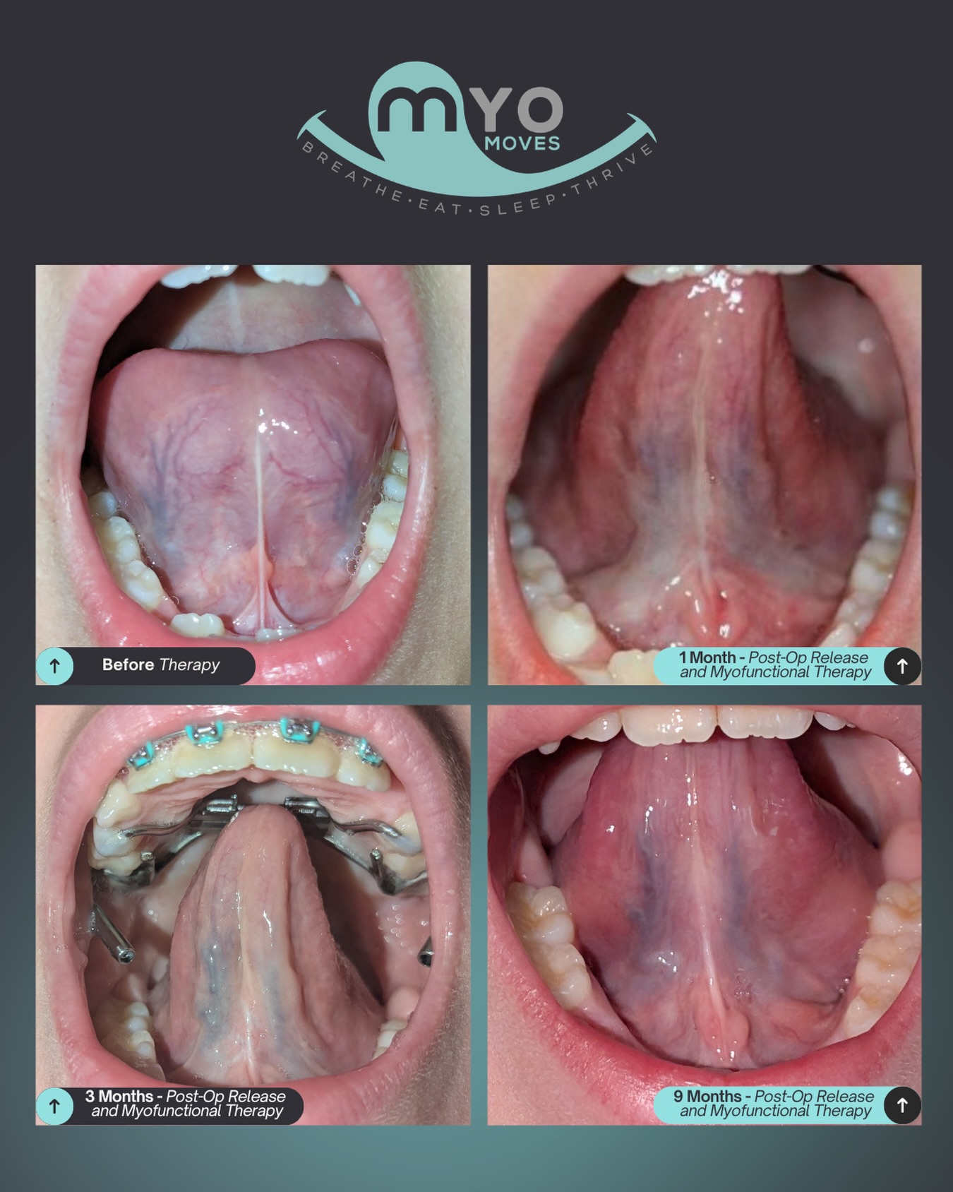 Look at this transformation!
This didn’t happen from one appointment or one provider.
This patient didn’t just get a tongue tie release and move on. We layered care:
• Myofunctional therapy to build awareness, strength, and coordination
• A tongue tie release so the tongue could actually move
• Expansion + a Herbst appliance to create space and support forward growth
Because function doesn’t live in isolation or happen overnight.
The tongue, the airway, the jaw, the posture—they all talk to each other.
You’ll see:
→ improved tissue mobility
→ better elevation and control
→ a tongue that finally has somewhere to go
This is the difference between doing a procedure and changing a pattern.
Huge shoutout to the team on this case:
• Release: Dr. Jennifer Wallace at Palmetto Smiles of Beaufort @palmettosmilesbft
• Orthodontic support: Dr. Travis Fiegle (expansion + Herbst) @winningorthodonticsmiles
Real change happens when we stop looking for a single fix and start building a team-based, airway-centered plan.
Not sure what your next step is?
Comment MYO and we’ll help guide you 🤍
#airwayhealth #myofunctionaltherapy #tonguetie #myo #palatalexpansion