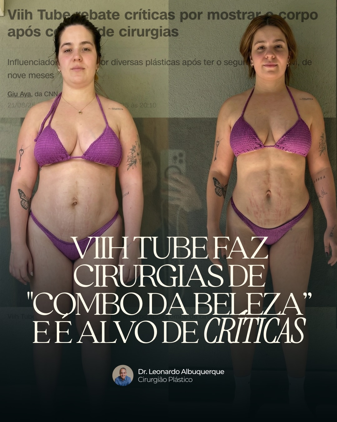 Você percebe flacidez abdominal ou “barriga estufada” após a gravidez?
Isso pode ser sinal de diástase abdominal ou excesso de pele pós-gestação — e muitas mulheres passam por isso sem entender o que está acontecendo.
Após a gestação, o corpo feminino sofre mudanças importantes: afastamento da musculatura abdominal (diástase), flacidez, acúmulo de pele e alteração das mamas. Esses fatores podem impactar não só a estética, mas também o conforto, a postura e a autoestima.
Casos como o da Viih Tube trouxeram esse tema à tona. Após a gravidez, ela passou por cirurgias no abdômen e mama e relatou medo e um processo mais intenso do que imaginava. Isso reforça um ponto importante: o que vemos nas redes sociais raramente mostra o processo completo.
Além da estética, muitas dessas alterações têm base estrutural, e nem sempre dieta, treino ou tratamentos não cirúrgicos conseguem resolver.
Sinais que merecem atenção:
- abdômen projetado mesmo com emagrecimento
- flacidez importante após gravidez
- excesso de pele abdominal
- dificuldade em recuperar o contorno corporal
- desconforto com roupas ou postura
Nesses casos, a avaliação com um cirurgião plástico permite identificar se há indicação de tratamento — que pode incluir desde acompanhamento até cirurgia.
A consulta envolve:
- diagnóstico individualizado
- avaliação da diástase e da pele
- planejamento seguro do tratamento
- orientação sobre o melhor momento para intervir
Nem toda paciente precisa operar, e nem todo momento é o ideal.
O mais importante é entender o que faz sentido para o seu corpo.
Se você está em Ilhéus ou região e apresenta esses sinais após a gestação, procure avaliação com um especialista.
📲 Agende sua consulta pelo link da bio.
Dr Leonardo Albuquerque | Cirurgia Plástica
Formado pela USP e membro da SBCP
CRMBA 23068 | RQE 10486
📍 Ilhéus - Bahia
.
.
.
.
Cirurgião plástico em Ilhéus
Diástase abdominal tratamento
Excesso de pele pós-gestação
Cirurgia plástica pós-parto
Contorno corporal após gravidez
#diastase #posgestacao #cirurgiaplastica #contornocorporal #drleonardoalbuquerque ilheusbahia cirurgiaplasticaemilheus