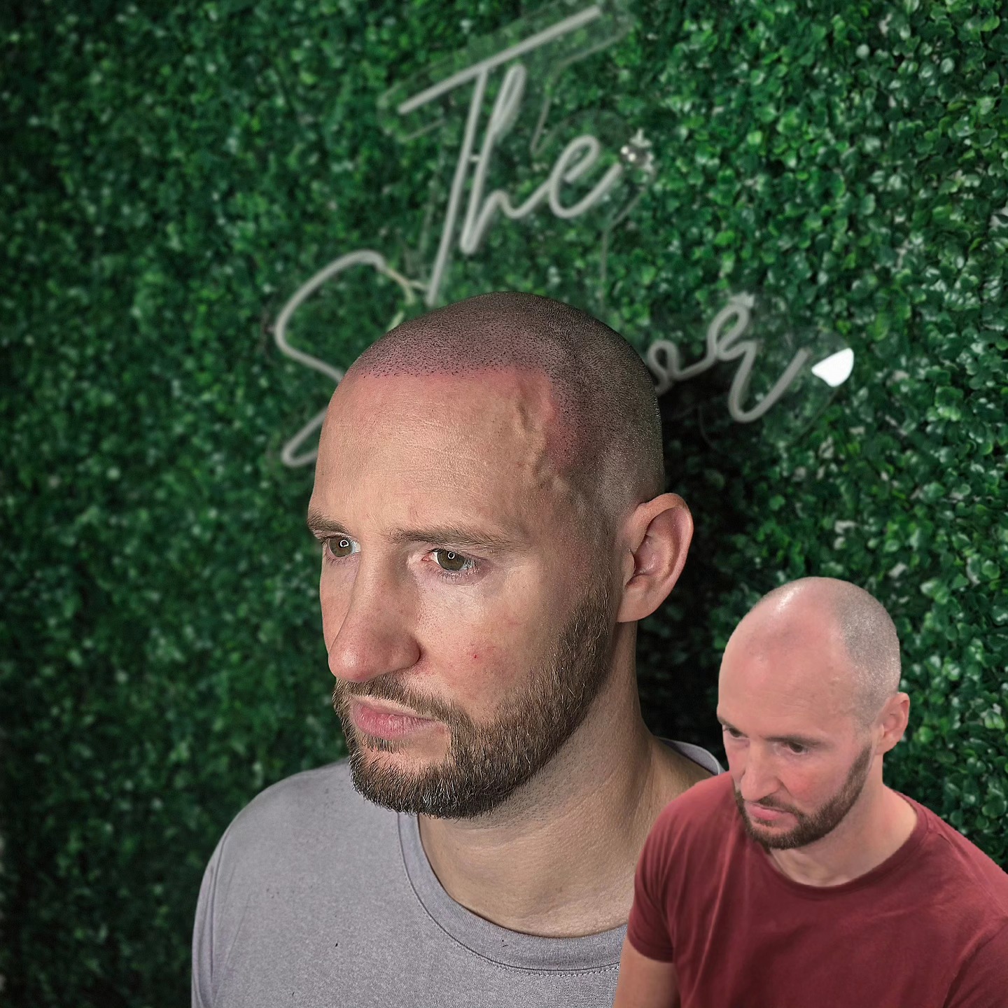 SMP TRANSFORMATION
Huge transformation!
3 sessions completed!
Face framed!
Detailed impressions!
Layered pigment!
Hyper-realistic natural looking results!
📍Bury St Edmunds
Enquire today to see how Scalp Micro-Pigmentation can help solve your hair loss insecurities!
🕸www.skinheadstudios.co.uk
#smp #smpartist #scalppigmentation #scalptattoo #scalpmicropigmentationtraining #scalpmicropigmentation #hairtattoo #hairlosssolution #newhair #growhair #hairregrowthtreatment #hairreplacement #hairtransplant #hairlosshelp #hairloss #recedinghairline #balding #bald #buzzcut #buzzfade #barber #tattoo #cosmetictattoo #beauty #menshair #menshealth #rogaine #finasteride #Rosemaryoil