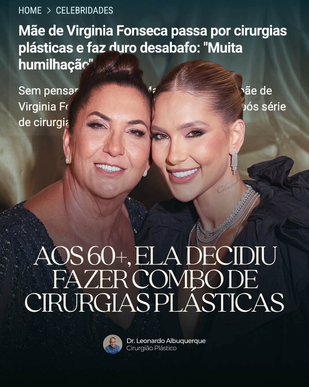 Você percebe flacidez, excesso de pele ou mudanças no rosto e corpo após os 60 anos?
Com o passar do tempo, a perda de colágeno e sustentação se torna mais evidente, afetando aparência, conforto e autoestima.
Casos como o de Margareth Serrão reacendem uma dúvida comum: ainda é possível fazer cirurgia plástica após os 60 com segurança?
Sim — desde que haja avaliação individualizada.
Nessa fase, os sinais mais frequentes são:
• flacidez facial e corporal
• perda de volume
• excesso de pele
• alteração da qualidade da pele
A indicação cirúrgica depende da saúde geral, condição da pele, riscos e expectativas de cada paciente.
Mais do que idade, o que importa é segurança e planejamento correto.
📲 Agende sua consulta pelo link da bio.
Dr Leonardo Albuquerque | Cirurgia Plástica
Formado pela USP e membro da SBCP
CRMBA 23068 | RQE 10486
📍 Ilhéus - Bahia
.
.
.
.
#cirurgiaplastica #rejuvenescimento #drleonardoalbuquerque #ilheusbahia